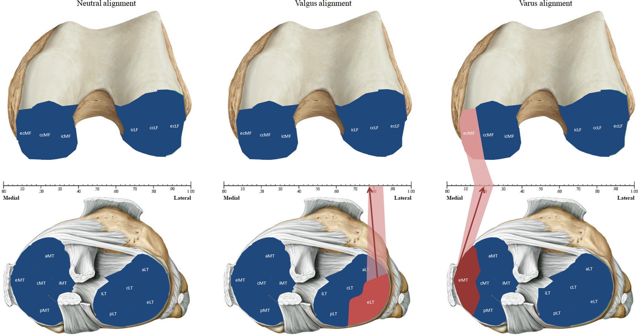 Fig. 7 
          Data derived from Table III show the analyzed subregions at the tibia (lower section) and the femur (upper section) with highlights of specific areas of high correlation between percentage of subchondral bone denuded of cartilage and its corresponding (x)-specific location. Colour-coded correlations: blue area, subregion with low statistical correlation (r > -0.6); pink area, subregion with high statistical correlation (r ≤ -0.7); red area, subregion with highest statistical correlation in its alignment group; arrow, (x)-location with highest statistical correlation in its alignment group. aLT, anterior lateral tibia; aMT, anterior medial tibia; ccLF, central lateral femur; ccMF, central medial femur; cLT, central lateral tibia; cMT, central medial tibia; ecLF, external central lateral femur; ecMF, external central medial femur; eLT, external lateral tibia; eMT, external medial tibia; icLF, internal central lateral femur; icMF, internal central medial femur; iLT, internal lateral tibia; iMT, internal medial tibia; pLT, posterior lateral tibia; pMT, posterior medial tibia.
        
