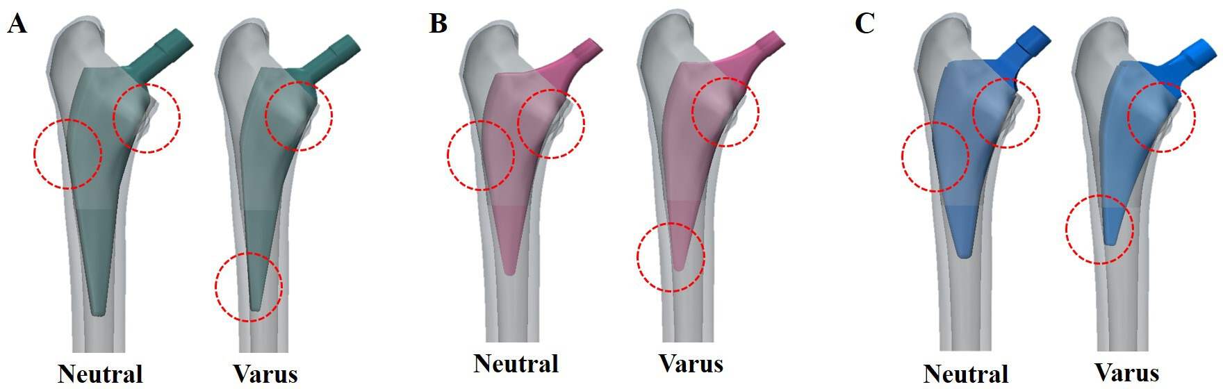 Fig. 1 
            The neutral and varus alignment of stems press-fit within the femoral canal; a) conventional stem, b) mid-short stem, and c) short stem. Dotted circles indicate medial and lateral interfaces in each stem.
          