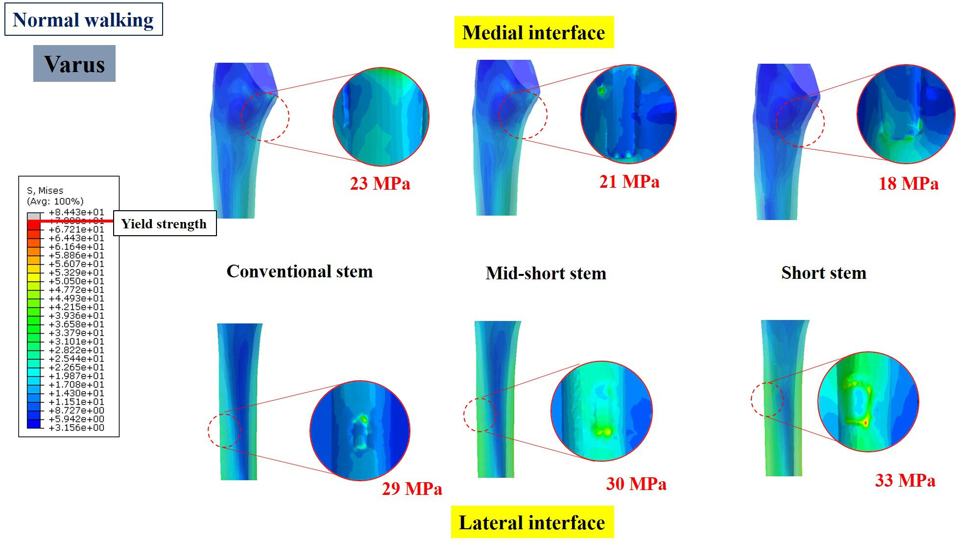 Fig. 3 
            Stress distribution at the medial and lateral interfaces of the cortical bone around the varus-inserted stem in normal walking condition. The circle images represent the stress concentration at medial calcar and lateral cortex region in contact with the stem tip. The number indicates the mean stress over a region of interest.
          