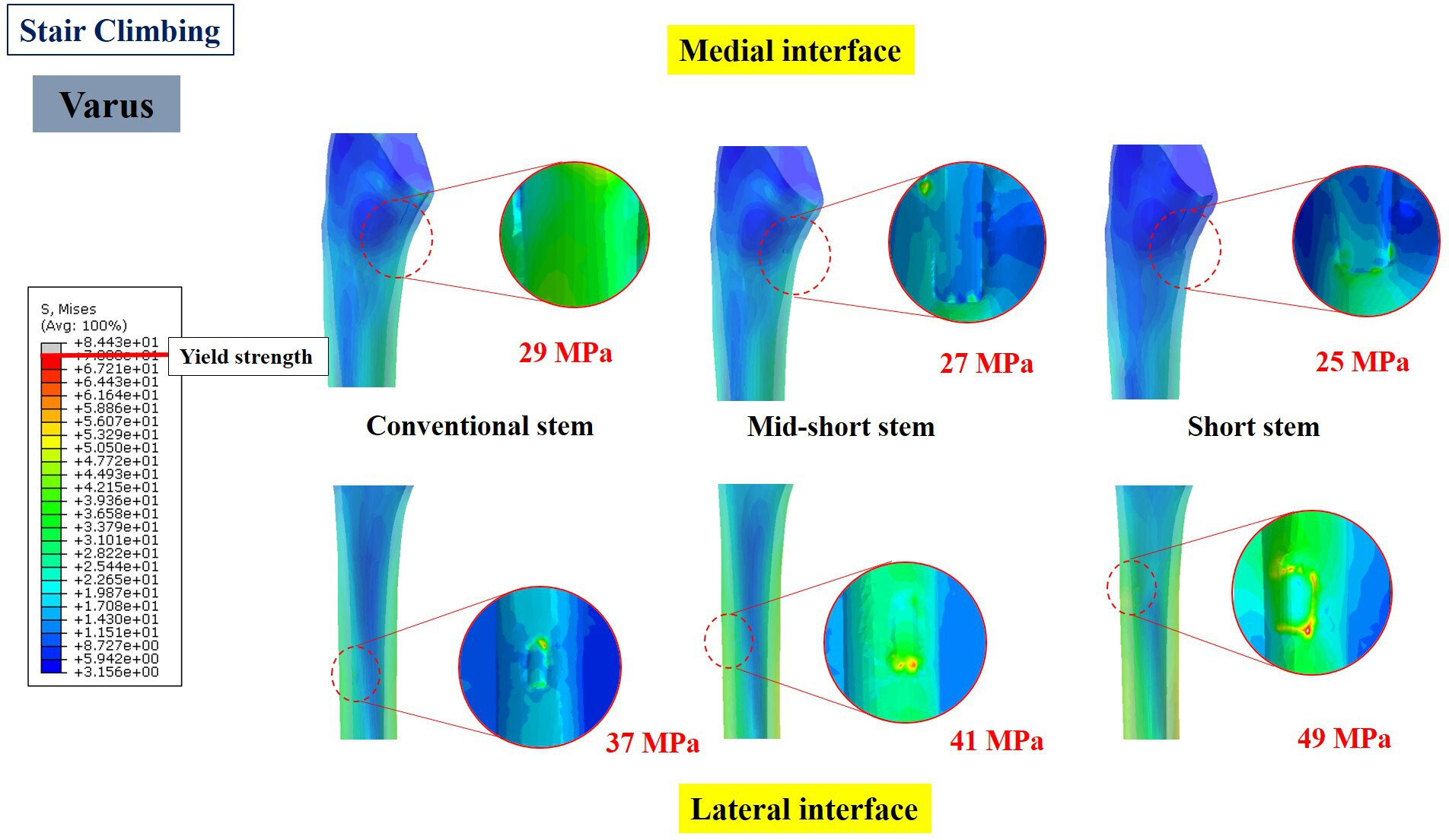Fig. 4 
            Stress distribution at the medial and lateral interfaces of the cortical bone around the varus-inserted stem in stair-climbing condition. The circle images represent the stress concentration at medial calcar and lateral cortex region in contact with the stem tip. The number indicates the mean stress over a region of interest.
          