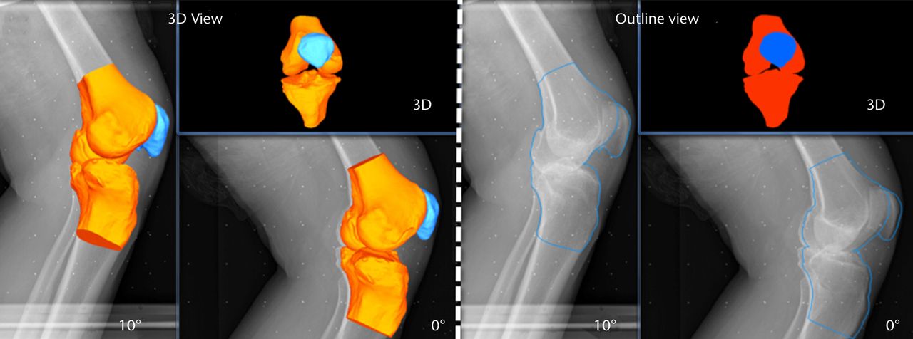 Figs. 5a - 5b 
            Images generated from the JointTrack
Biplane software in three-dimensional (3D) view and silhouette view
for a) the post-operative and b) the pre-operative knees.
          