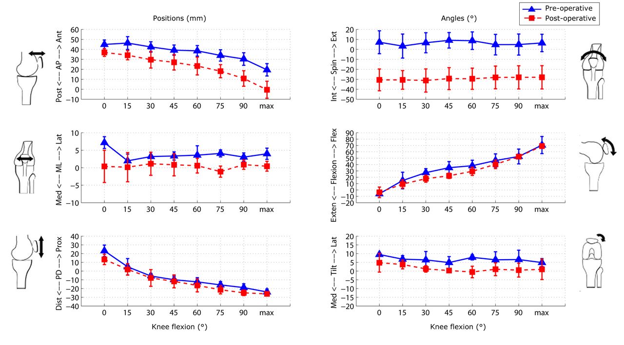 Fig. 6 
          Graphs showing the mean results for
the six degrees of freedom patellofemoral tracking in the pre- and
post-operative knees. The error bars denote the standard deviation
(AP, anteroposterior; ML, mediolateral; PD, proximodistal; Int,
internal; Ext, external; Exten, extension; Flex, flexion; Med, medial;
Lat, lateral).
        