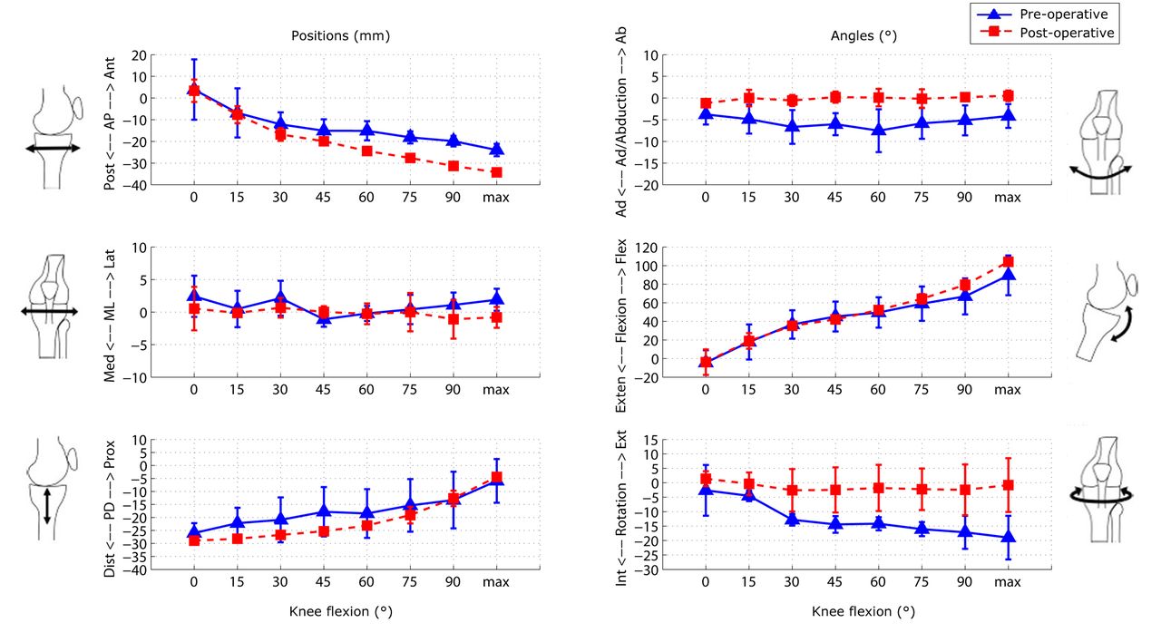Fig. 7 
          Graphs showing the mean results for
the six degrees of freedom tibiofemoral tracking in the pre- and
post-operative knees. The error bars denote the standard deviation
(AP, anteroposterior; ML, mediolateral; PD, proximodistal; Int,
internal; Ext, external; Exten, extension; Flex, flexion; Med, medial;
Lat, lateral).
        