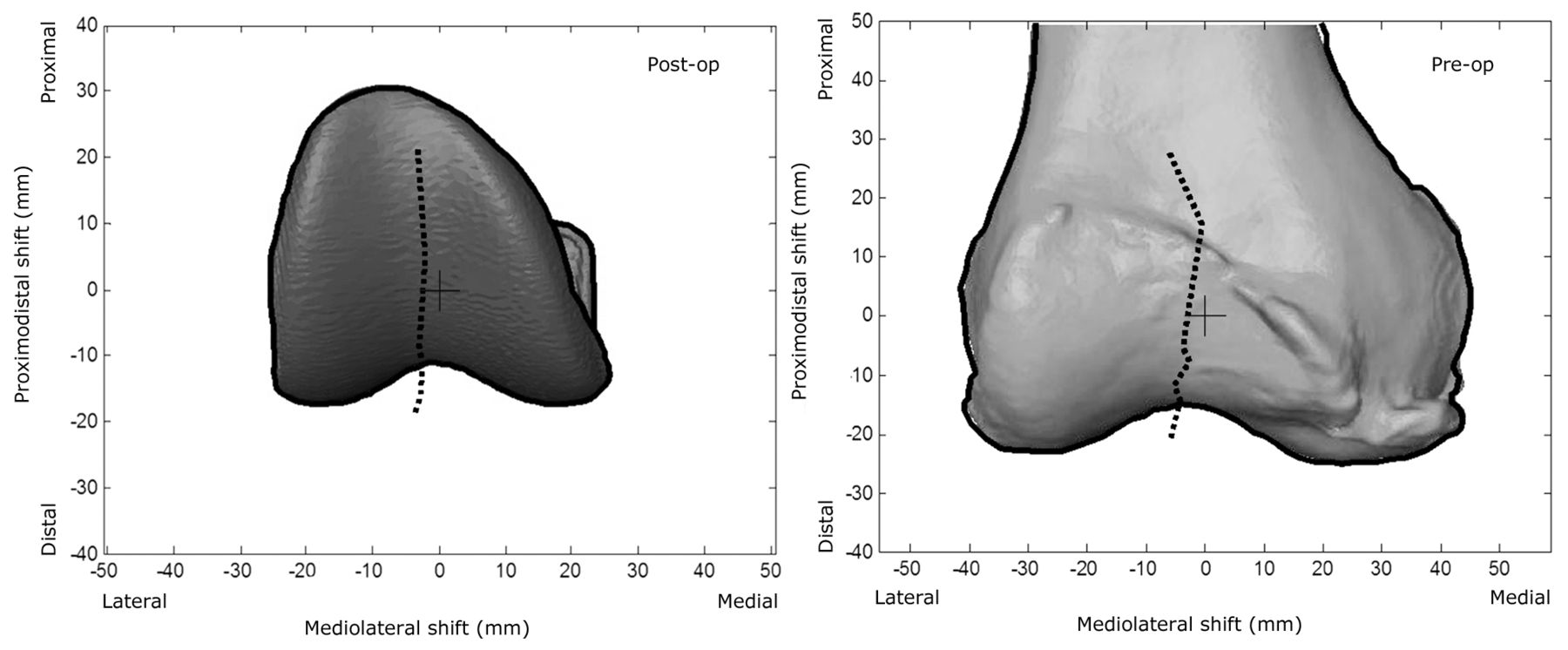 Fig. 8 
          Diagrams showing the mean patellar prosthesis/bone shift
relative to the femoral groove centre, overlaid on an individual
subject’s femoral prosthesis/femur. The black cross is the origin
of the femoral prosthesis/femur and the black dotted line is the
tracking of the patella as the knee flexes.
        