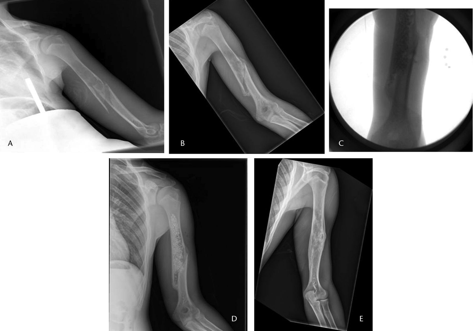 Fig. 1 
          Radiographs of a 16-year-old male patient,
a) at presentation, showing a pathological fracture of the left
humerus through a unicameral bone cyst, b) at two months after treatment
in a sling with interval healing, c) and d) after percutaneous curettage
and bone grafting, respectively, and e) at two years post-operatively,
showing a healed cyst.
        