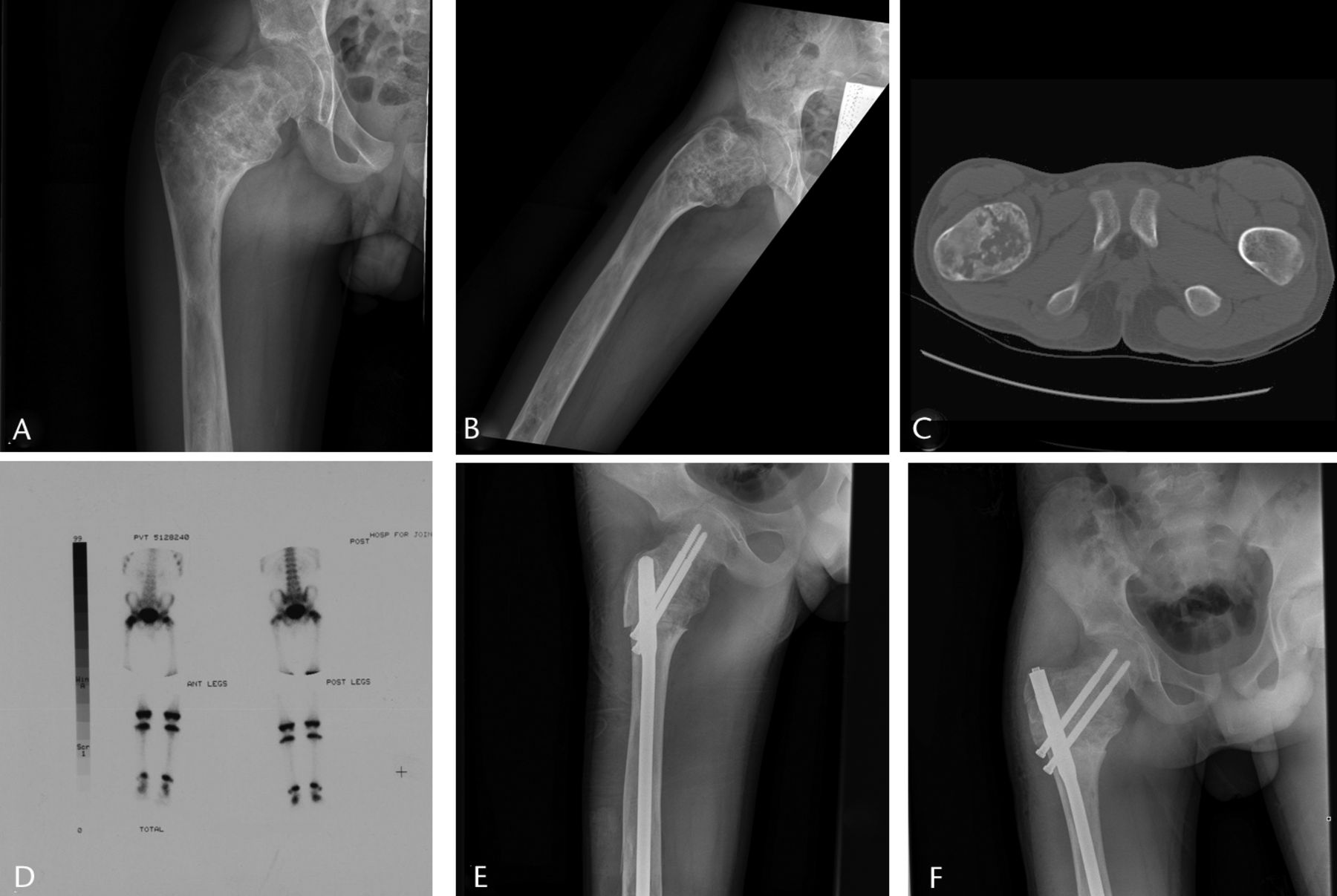Fig. 3 
          Imaging in a 14-year-old male patient
with a sudden onset of right hip pain, a) and b) radiographs at
presentation, showing a Shepherd deformity and pathological fracture
of the proximal femur, c) an axial CT scan showing the fracture,
d) a bone scan, used to rule out polyostotic fibrous dysplasia,
showing that it was confined to the right proximal femur, e) after
proximal femoral osteotomy to correct the deformity and fixation
with intramedullary nail, and f) at two months post-operatively
showing healing of the fracture and osteotomies, at which point
the patient had no pain.
        