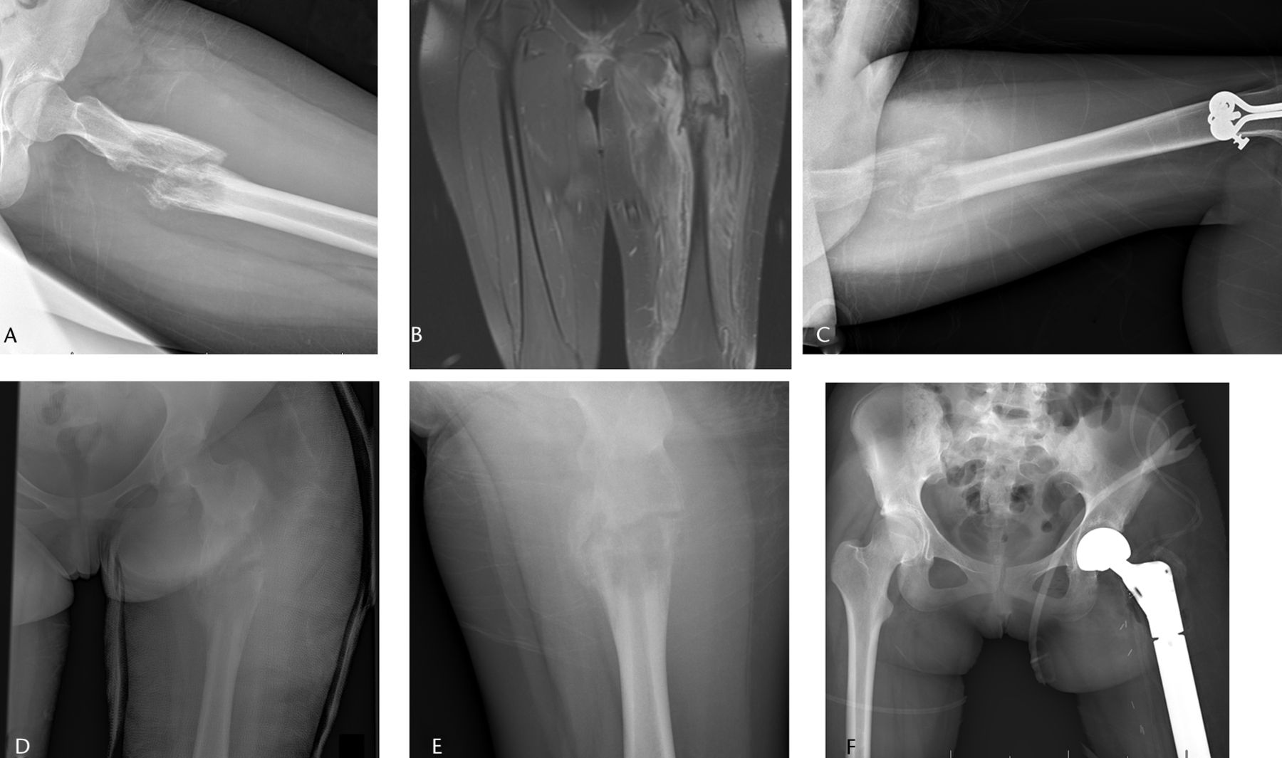 Fig. 4 
          Imaging in a 15-year-old female patient,
a) radiograph at presentation, showing a pathological fracture through
a malignant-appearing lesion of the proximal femur, b) coronal STIR T1-weighted
post-contrast MRI showing the fracture, associated haematoma and
soft-tissue mass, after which a biopsy confirmed a diagnosis of
Ewing sarcoma. The patient underwent six weeks in traction (c) and
six further weeks in a spica cast (d). After neoadjuvant chemotherapy,
the fracture healed (e) and patient underwent a wide resection of
a proximal femoral mass with endoprosthetic replacement (f).
        