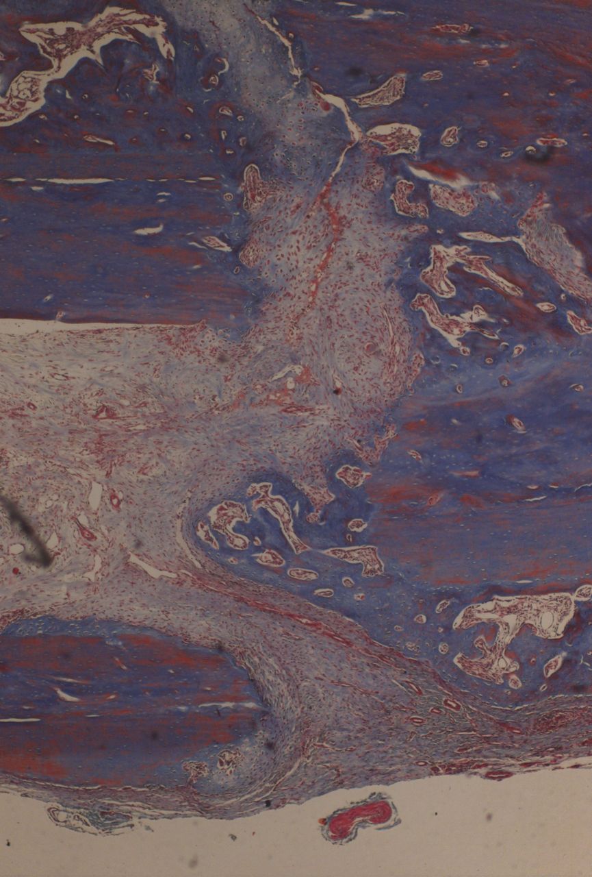 Fig. 5 
            Histological images of Masson’s trichrome
×4 magnification in a specimen of external fixation. Note rim of
external callus and new woven bone formation.
          
