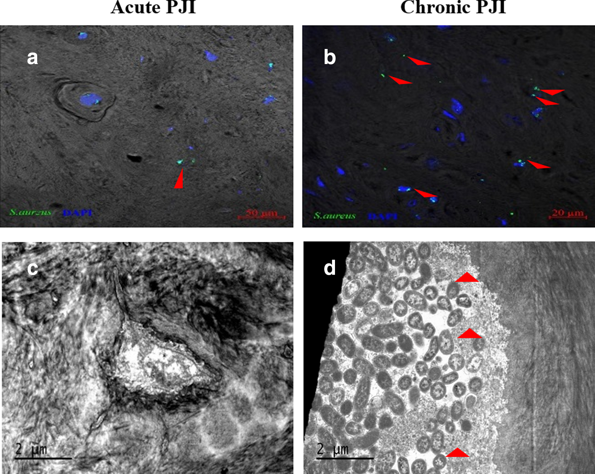 Fig. 2 
            a) to b) Immunofluorescence and c) to d) transmission electron microscopy results of acute and chronic Staphylococcus aureus periprosthetic joint infection (PJI) bone tissues: there was more S. aureus colonization in chronic PJI bone tissues than in acute PJI (indicated by red arrows). DAPI, 4′,6-diamidino-2-phenylindole.
          