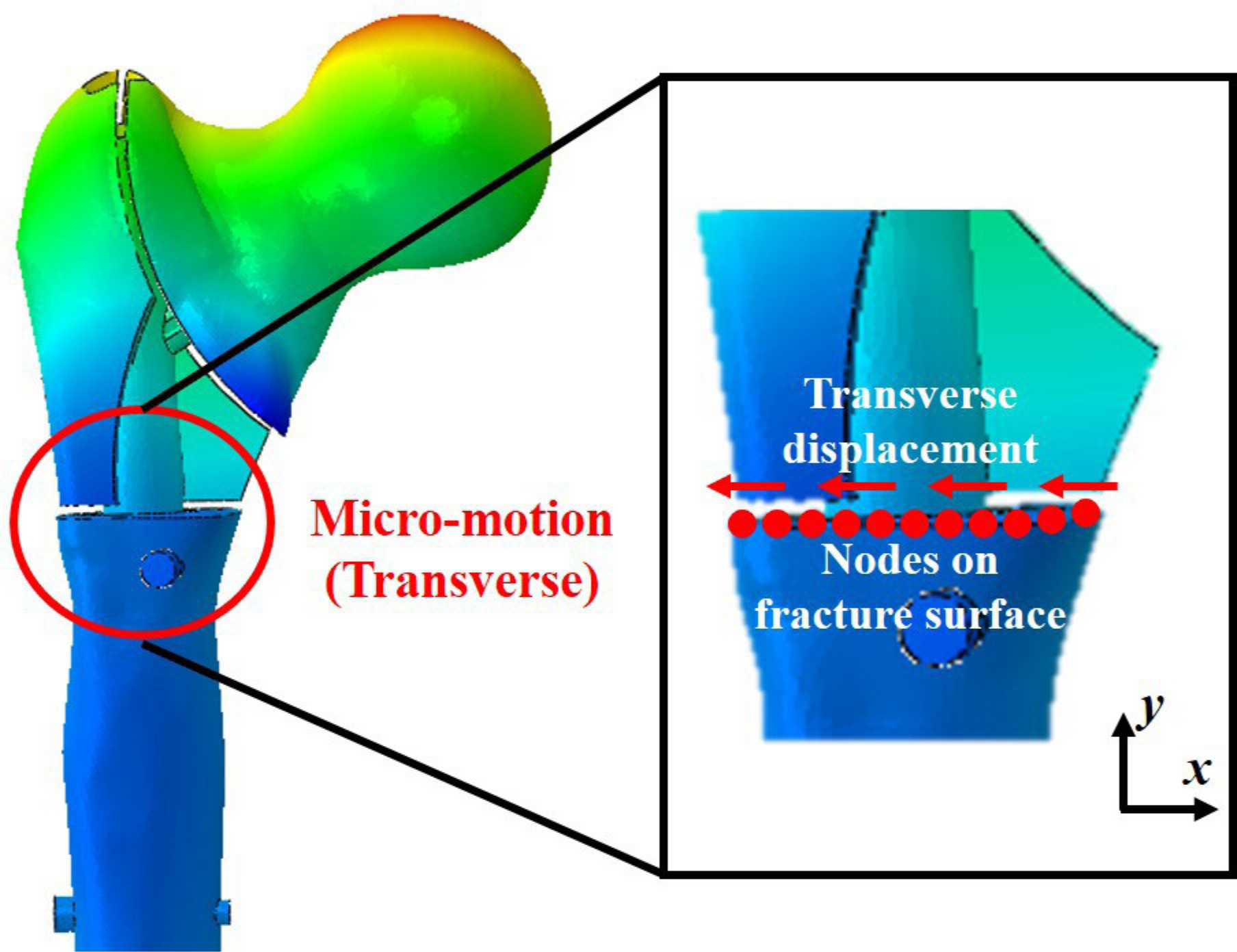 Fig. 3 
            Micromotion (μm) of the distal fragment related to the proximal fragment was measured through the mean coronal displacement of all nodes on the fracture surface before and after applying axial loading on finite element model.
          