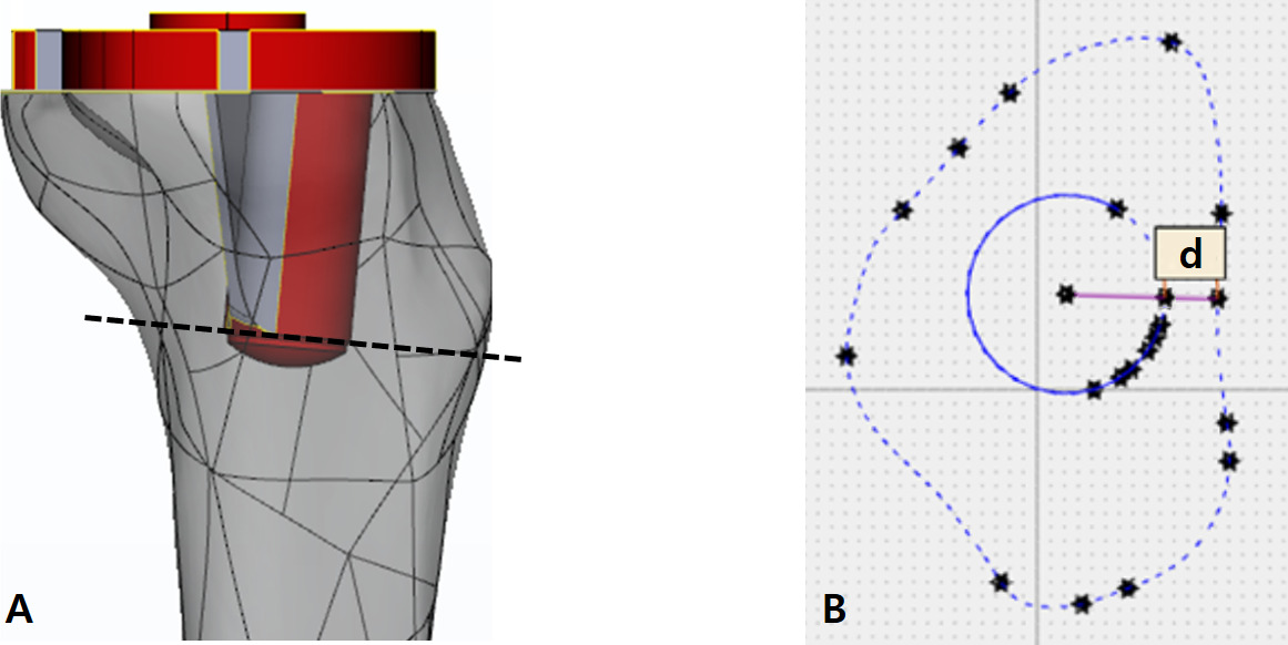 Fig. 3 
            a) Surgical simulations of anatomical tibial component. b) The plane perpendicular to the stem axis at the most distal end. d = the shortest distance between distal stem tip and anteromedial cortical bone.
          