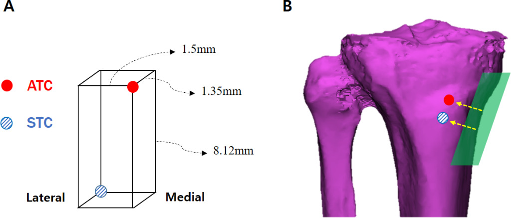Fig. 4 
          a) Schematic composite image showing the positional relationship of the central point of the stem tip metal portion when anatomical tibial component (ATC) and symmetric tibial component (STC) are inserted with the same reference. b) Due to the oblique orientation of anteromedial cortical bone, there is no statistical difference in the shortest distance between two implants.
        