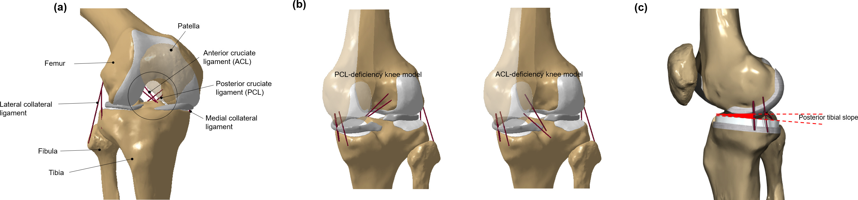 Fig. 1 
            Finite element models in analysis for a) intact, b) anterior cruciate ligament (ACL) deficiency and posterior cruciate ligament (PCL) deficiency, and c) unicompartmental knee arthroplasty (UKA) model.
          