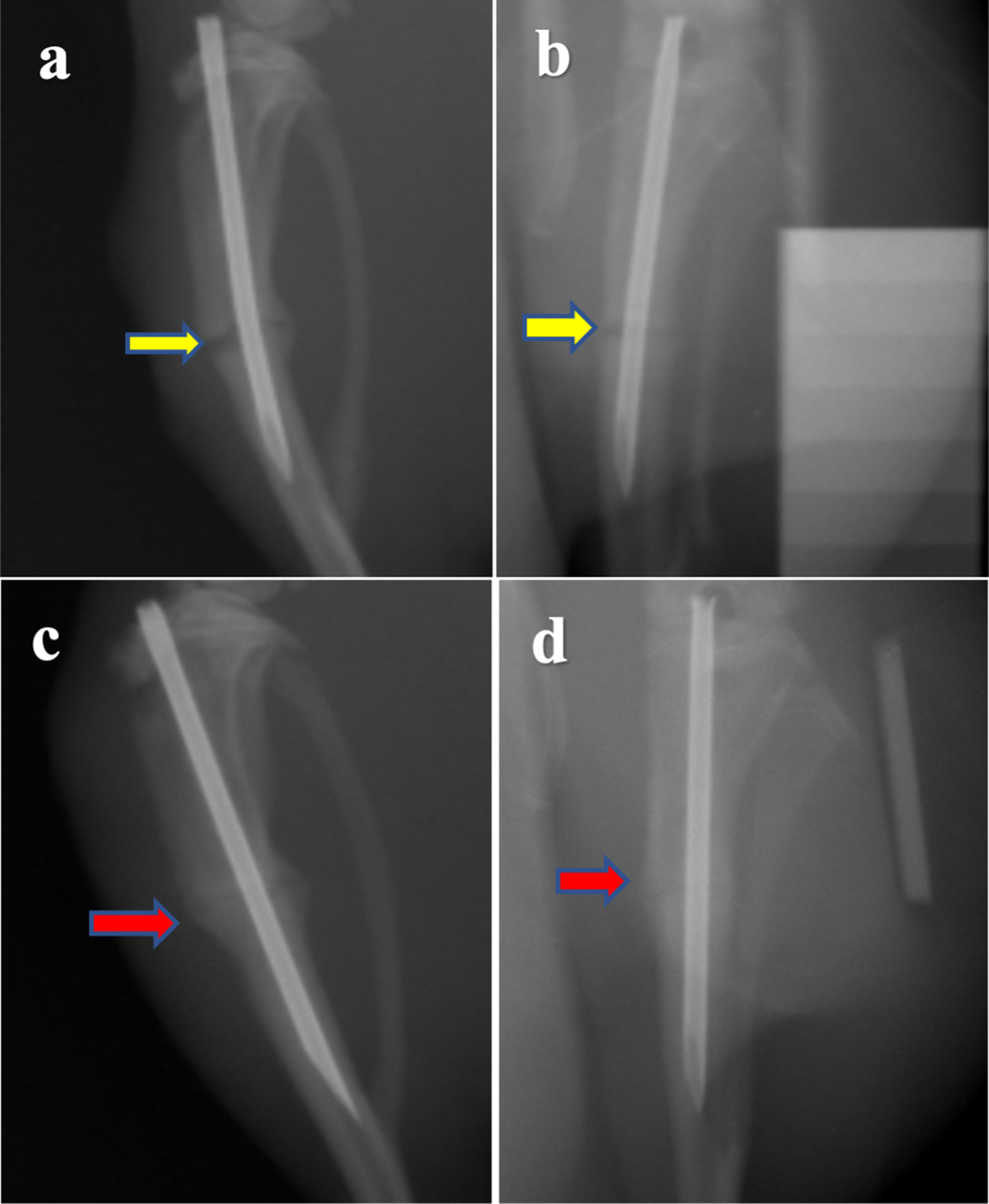 Fig. 1 
            Lateral and anteroposterior radiographs showing a) and b) a nonunion tibia (yellow arrows) in Group 1, and c) and d) a united tibia (red arrows) in Group 2, four weeks after surgery.
          