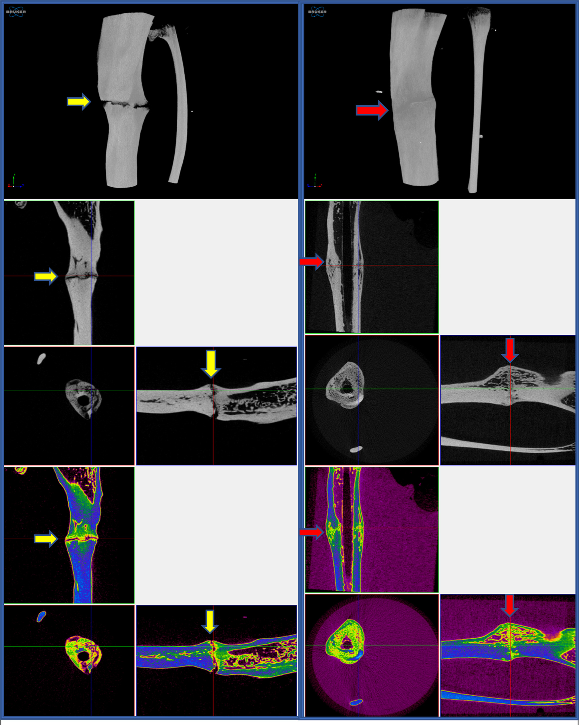 Fig. 3 
            3D (top) and three-sectional (middle and bottom) images, showing nonunion (yellow arrows) in the anti-retroviral therapy group (left) and union (red arrows) in the control group (right).
          
