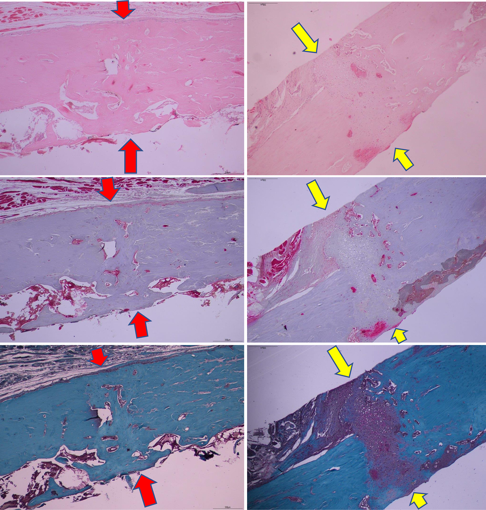 Fig. 4 
            The histological difference between the control group with union (red arrows) (left) and the anti-retroviral therapy group with nonunion (yellow arrows) (right). Haematoxylin and eosin, Masson’s trichrome, and safranin O/fast green stains were used (magnification: 40×).
          