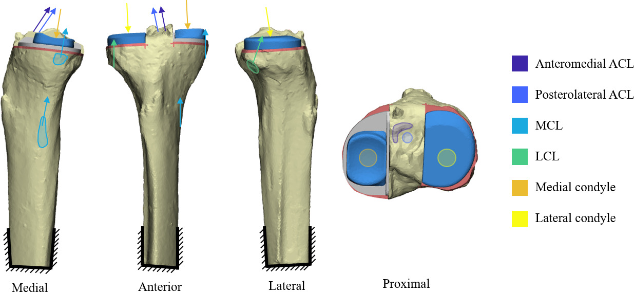 Fig. 1 
            Bi-unicondylar knee arthroplasty baseline with representation of loading. ACL, anterior cruciate ligament; LCL, lateral collateral ligament; MCL, medial collateral ligament.
          