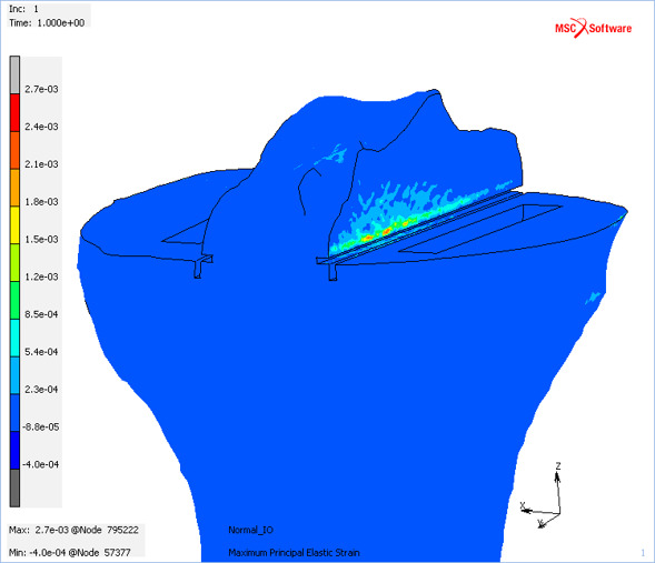 Fig. 2 
          Maximum principal elastic strain in the male baseline bi-unicondylar knee arthroplasty model for the balanced loadcase. Blue indicates low/compressive strains and red indicates the highest predicted tensile strains.
        