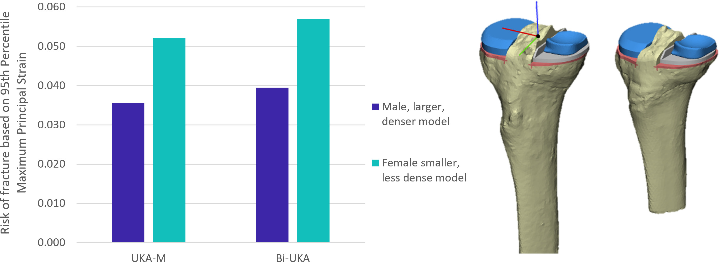 Fig. 5 
            Bar graph showing the risk of fracture in isolated medial unicondylar knee arthroplasty (UKA-M) and bi-unicondylar knee arthroplasty (Bi-UKA) when the knee is balanced in the male (dark blue) and female (turquoise) tibiae.
          