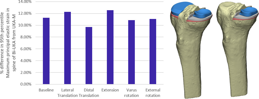 Fig. 6 
            Bar graph showing the percentage difference in maximum principal elastic strain (MPES)-95 measured in the medial portion of the spine of bi-unicondylar knee arthroplasty (Bi-UKA) from isolated medial unicondylar knee arthroplasty (UKA-M), when the implants are positioned as planned, and with typical surgical variation applied to the medial implant.
          