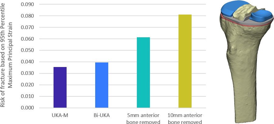 Fig. 7 
            Bar graph showing the risk of fracture in isolated medial unicondylar knee arthroplasty (UKA-M) and bi-unicondylar knee arthroplasty (Bi-UKA) when the knee is balanced, and when 5 mm and 10 mm of bone is removed anteriorly.
          