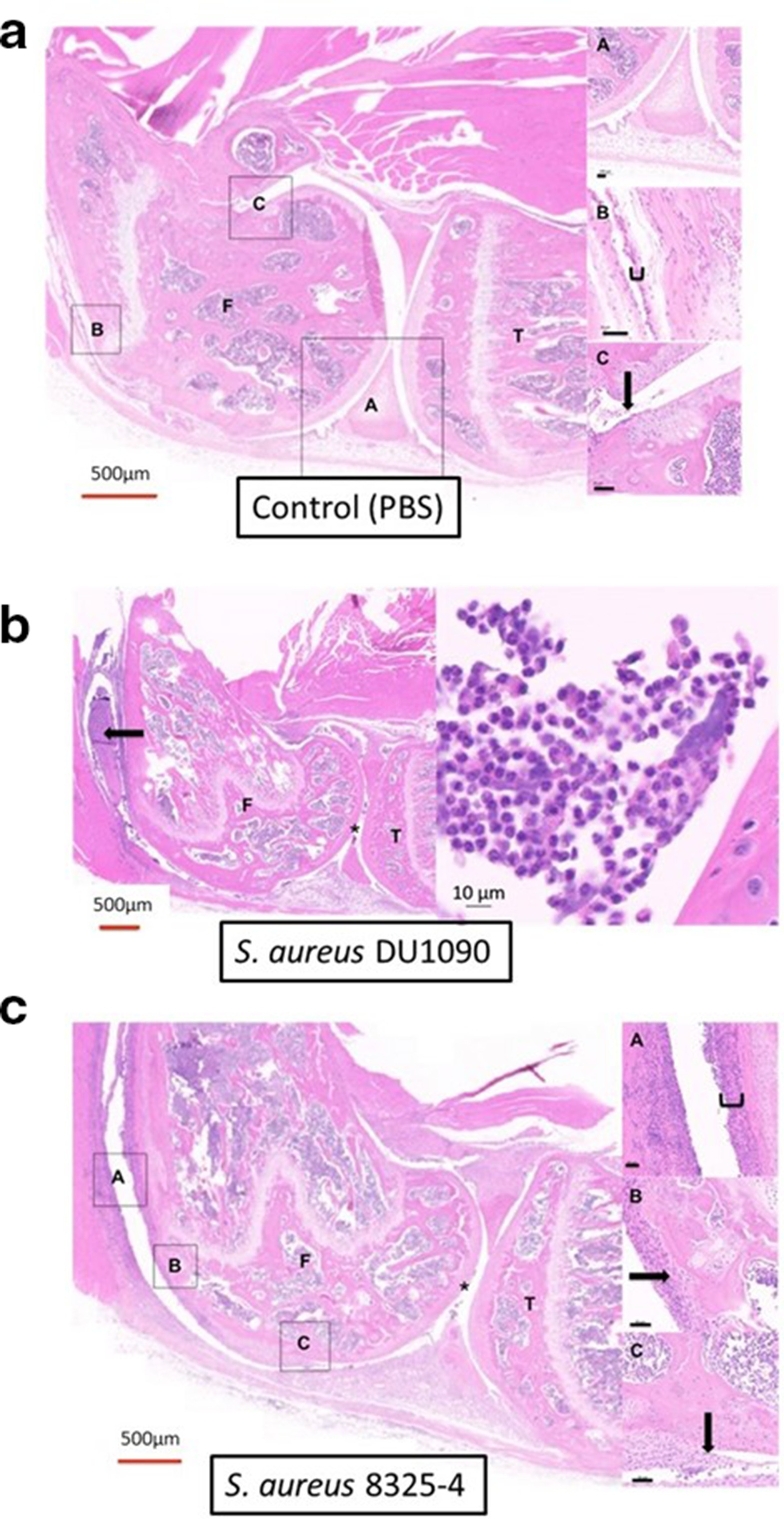Fig. 2 
            Histological appearance of the right stifle joints of mice following injection with or without bacteria. a) A control (phosphate-buffered saline (PBS)) joint seven days following injection illustrating normal joint architecture (F = femur, T = tibia). A = normal articular cartilage with no evidence of inflammatory cells within the joint space; B = single layer of synovium; and C = normal cartilage-synovium interface with absence of pannus formation. Red scale bar = 500 μm, black scale bars = 50 μm. b) A joint two days following injection with Staphylococcus aureus DU1090, including a magnified view of the inflammatory infiltrate. There was an increased joint space secondary to effusion and the presence of inflammatory cells in the joint (horizontal arrow). There was mild synovial hypertrophy visible either side of this and very early pannus formation. The inflammatory infiltrate was dominated by neutrophils. Red scale bar = 500 μm. c) Appearance seven days after joint injection with S. aureus 8325-4. Images on the right: (a), (b) and (c) are magnified from the main picture on the left. There was: (a) severe synovial hypertrophy (block), (b) bone erosions (horizontal arrow), and (c) pannus formation (downward arrow). Despite this, the majority of the articular surface appeared to be macroscopically intact (asterisk). Magnification: ×60.
          