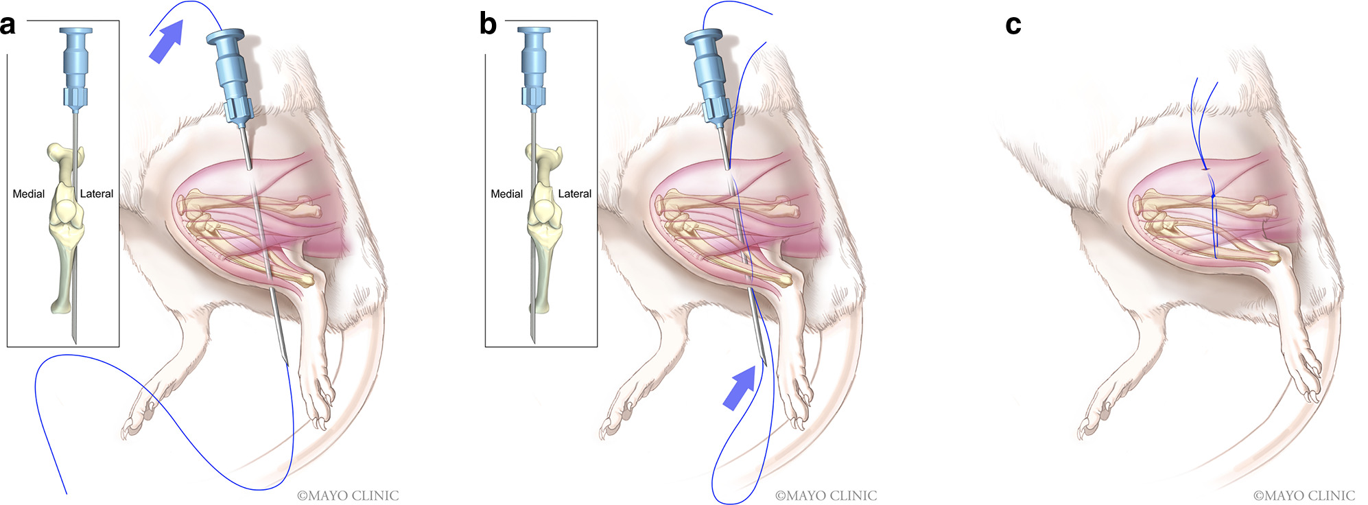 Fig. 2 
            Percutaneous fixation technique used in novel arthrofibrosis mouse model. a) A 21-gauge needle was introduced laterally to the lower limb through a lateral portal between the proximal femur and the distal tibia and a 3-0 nonabsorbable suture was shuttled using the needle. b) After removal, the same needle was introduced through the same lateral portal but medially to the femur, resulting in the creation of a loop with the suture. c) A sliding knot was used to tighten and fix the knee joint at 150° of flexion. The wound was closed and the knot was placed under the skin at the lateral part of the thigh.
          
