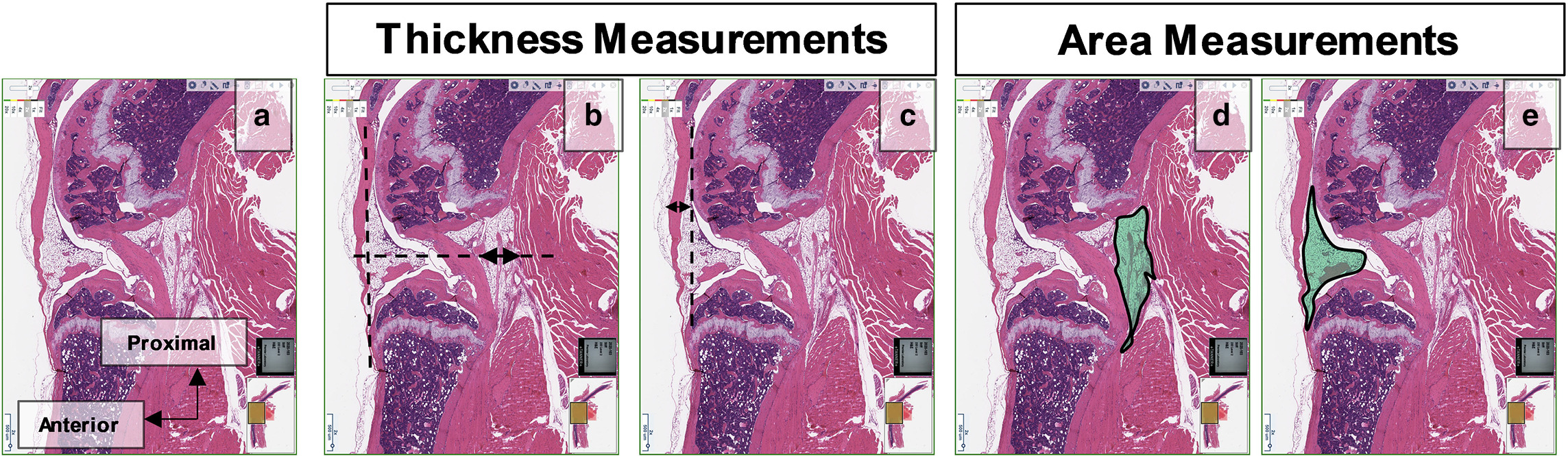 Fig. 4 
            Histological assessment of novel arthrofibrosis mouse model. The pictures shown summarize histological methods and measurements that were used to assess knee joints in the present study. a) A central section of a control mouse knee after haematoxylin and eosin staining. b) Measurement of the posterior capsule thickness using a line perpendicular to the patellar tendon axis. c) Measurement of the patellar tendon thickness at mid-distance between the apex of the patella and the anterior tibial tuberosity. d) The area of the posterior capsule was measured by manual contouring. e) The area of the Hoffa fat pad was measured by manual contouring.
          