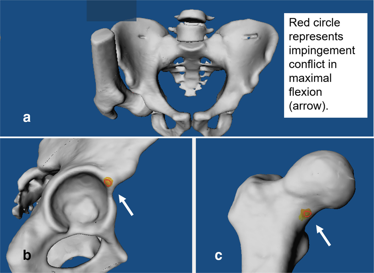 Fig. 1 
            a) CT-based 3D model of the pelvis and proximal femur is shown of a patient with cam-type femoroacetabular impingement. Impingement simulation in maximal flexion shows b) acetabular and c) femoral intra-articular impingement conflict (red circle, arrow).
          