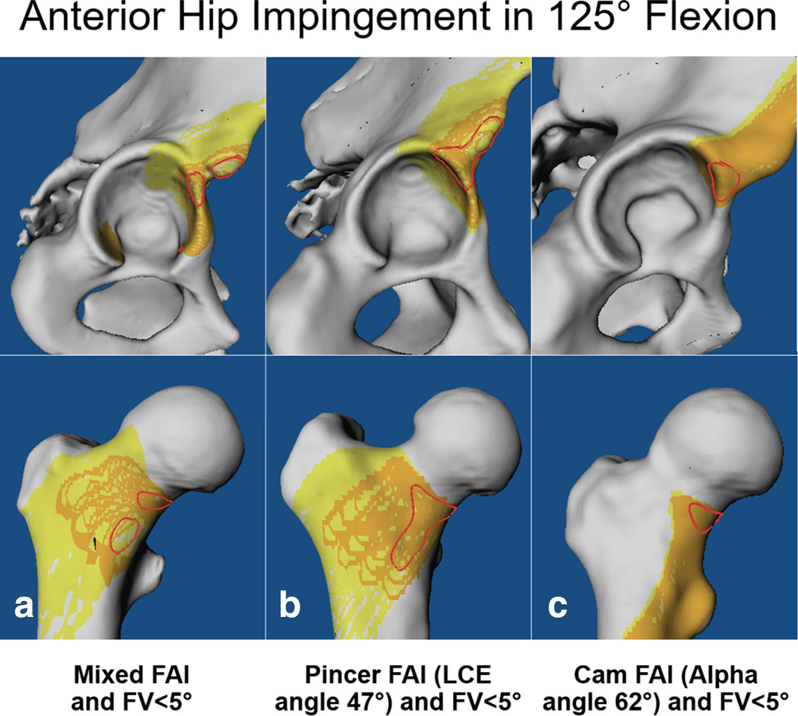 Fig. 2 
          Location of acetabular (top) and femoral (below) impingement for the three study groups (a) mixed-type femoroacetabular impingement (FAI), b) pincer-type FAI, and c) cam-type FAI) of patients with decreased femoral version (FV < 5°) is shown for 125° of flexion.
        