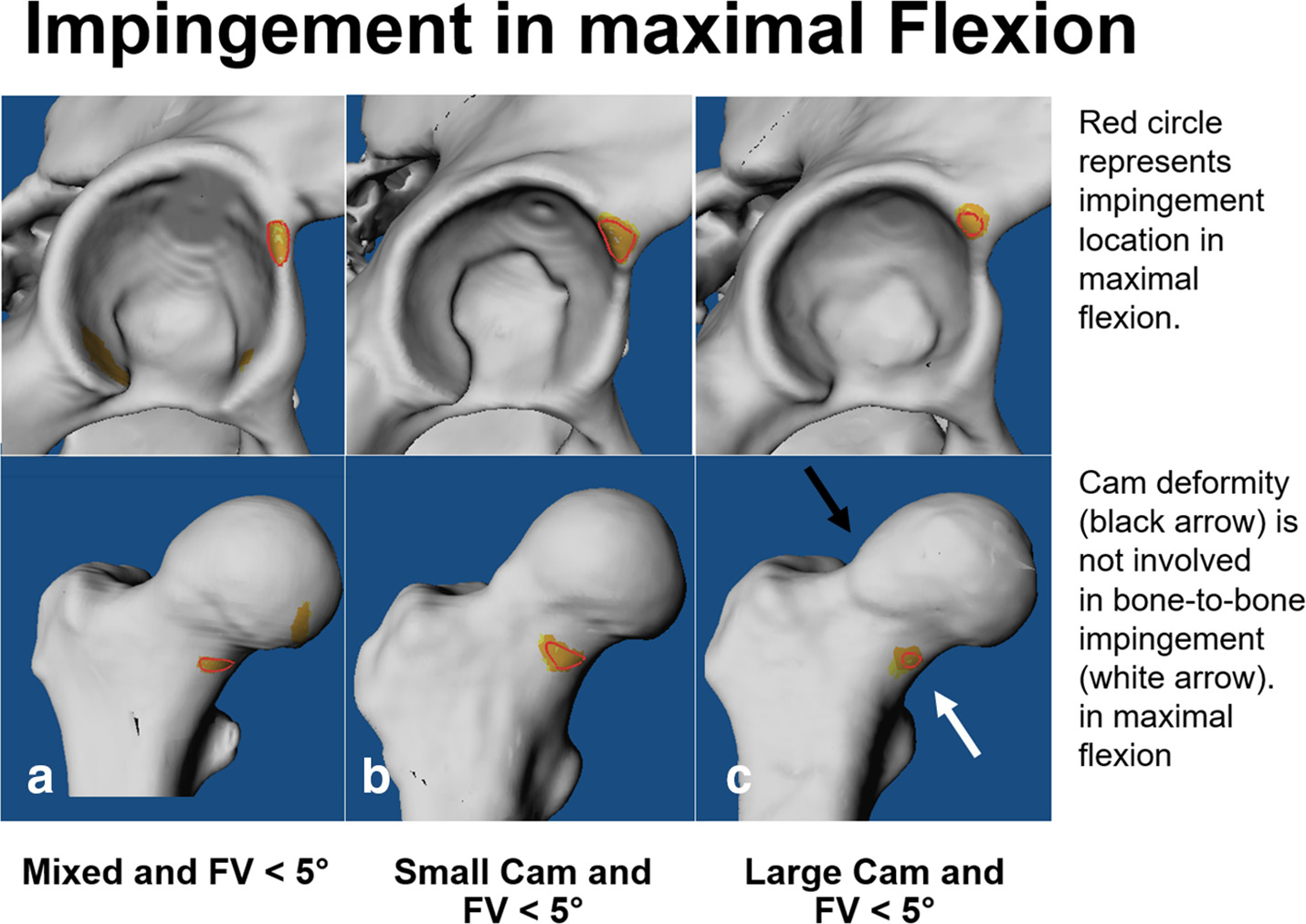 Fig. 4 
          Location of acetabular (top) and femoral (below) impingement in maximal flexion is shown for three patients with decreased femoral version (FV < 5°): a) a patient with mixed-type femoroacetabular impingement, b) a patient with a small cam deformity, and c) a patient with a large cam deformity.
        
