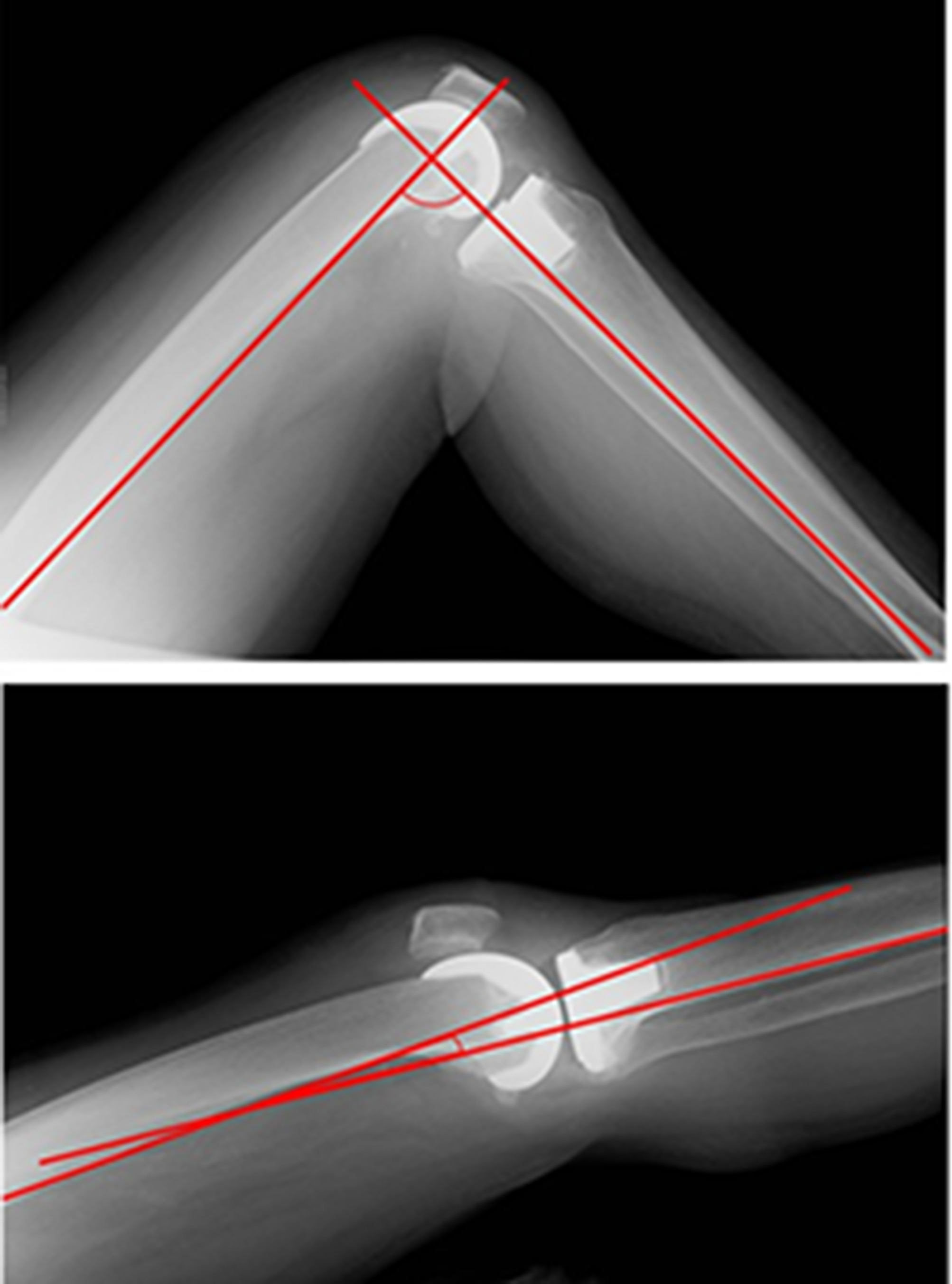 Fig. 1 
            Lateral radiograph of a 68-year-old female patient in 2021. Above: flexion position. Below: extension position.
          