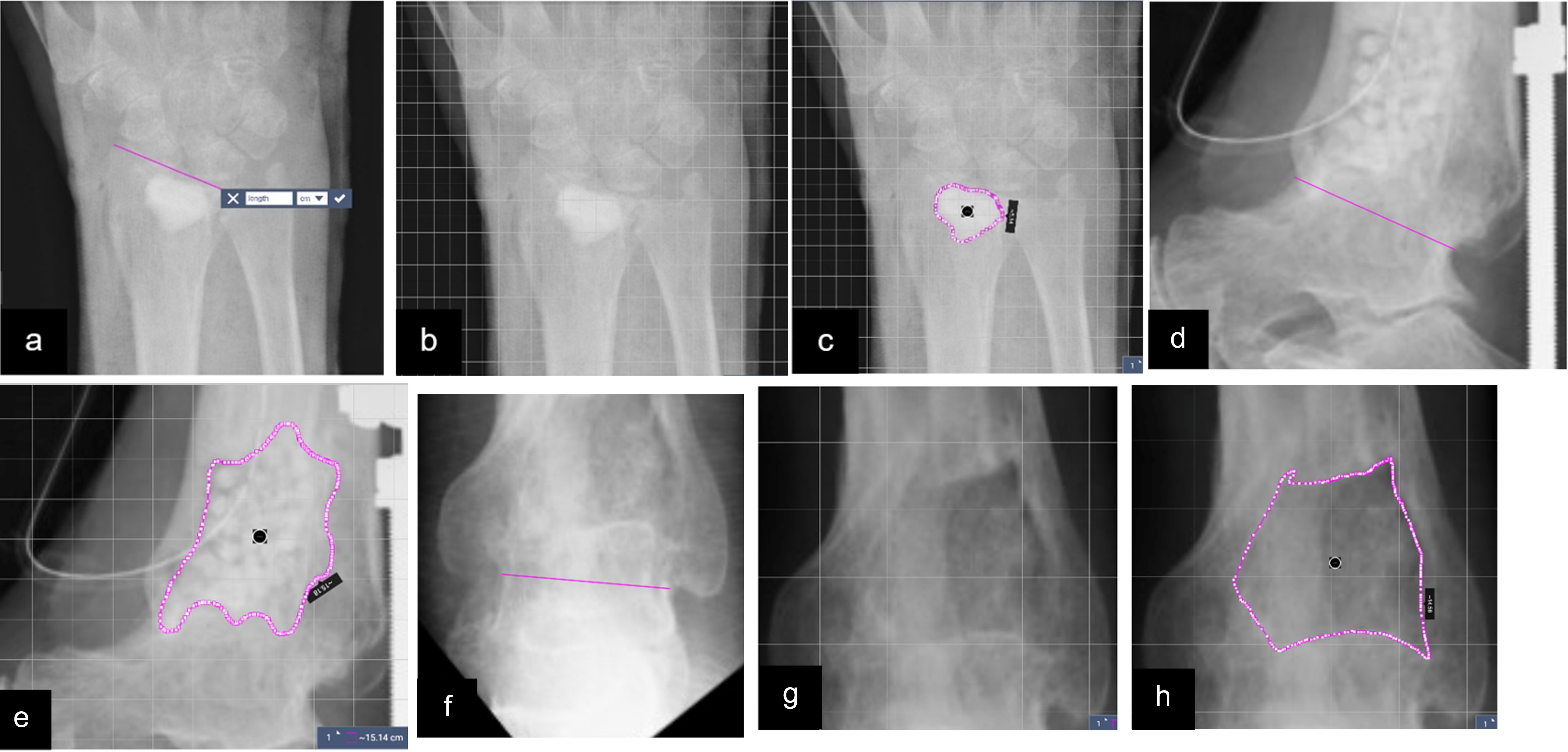 Fig. 1 
            Radiographs demonstrating the technique for measuring bone-void healing. Figures a) to c) show the immediate postoperative radiograph of an 85-year-old woman taken after insertion of Cerament G into a distal radial osteomyelitis void. a) A fixed landmark is measured using the SketchAndCalc Area Calculator software.22 b) A calibration scale is applied, and c) the circumference of the carrier is mapped out. This is repeated for the lateral view. Figures d) and e) show the same process for an immediate postoperative lateral radiograph in a 57-year-old man with a distal tibial osteomyelitis void above a previous ankle fusion treated with Osteoset T. Figures f) to h) demonstrate the degree of bone healing at final follow-up on the anteroposterior (AP) radiographs (one year following surgery). The degree of bone healing is calculated on both the AP and lateral views.
          