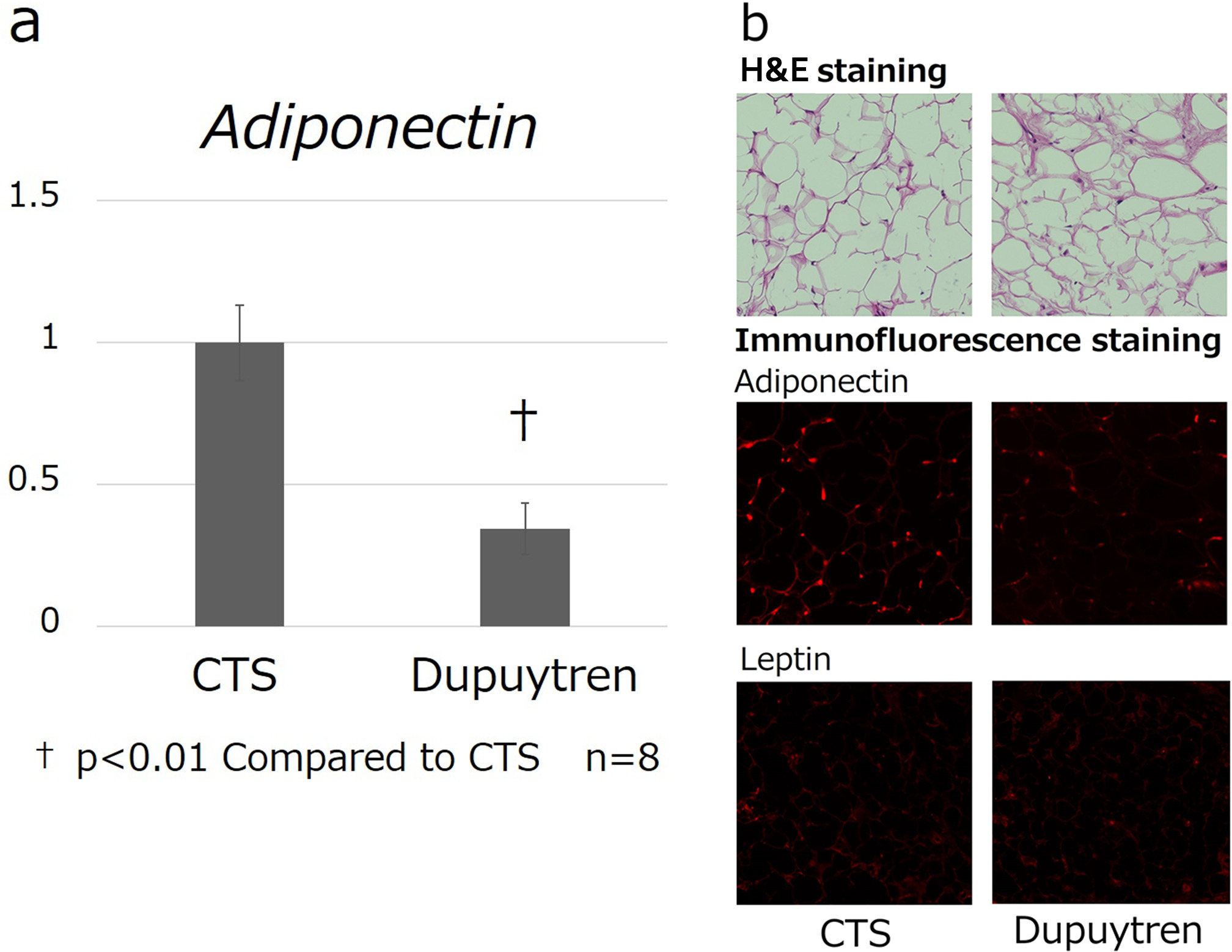 Fig. 1 
            a) Adiponectin gene expression was significantly decreased in the Dupuytren’s contracture group compared to that in the carpal tunnel syndrome (CTS) group (p < 0.001) (n = 8). Gene expression was normalized against the CTS. All results are expressed as means and standard error. b) Fluorescence immunohistochemical staining showing decreased protein expression in the Dupuytren’s contracture group compared to the CTS group (20×). H&E, haematoxylin and eosin.
          