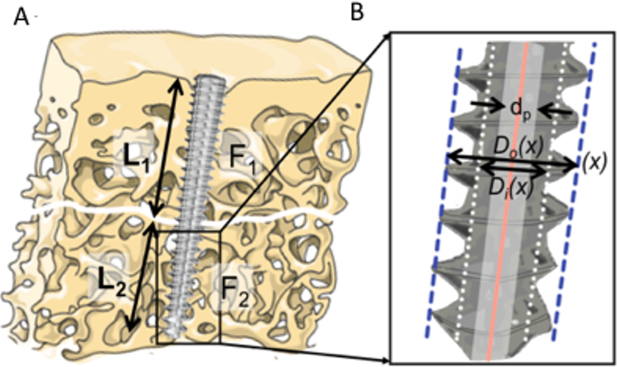 Fig. 4 
          a) The pullout force of the headless screw fixation originating from F1 or F2. When F1 < F2, the proximal fragment would be pulled out. Conversely, when F1 > F2, the fragment and screw would be pulled out together. b) The pullout force of the screw is associated with the screw design and diameter of the predrilling tunnel (dp). F(1 or 2), the pullout force of the screw; L(1 or 2), the screw length within the bone; X, the specific x position along the screw length; Di(X), inner diameter of the screw at X position; Do(X), outer diameter of the screw at X position; dp, diameter of the predrilling tunnel.
        