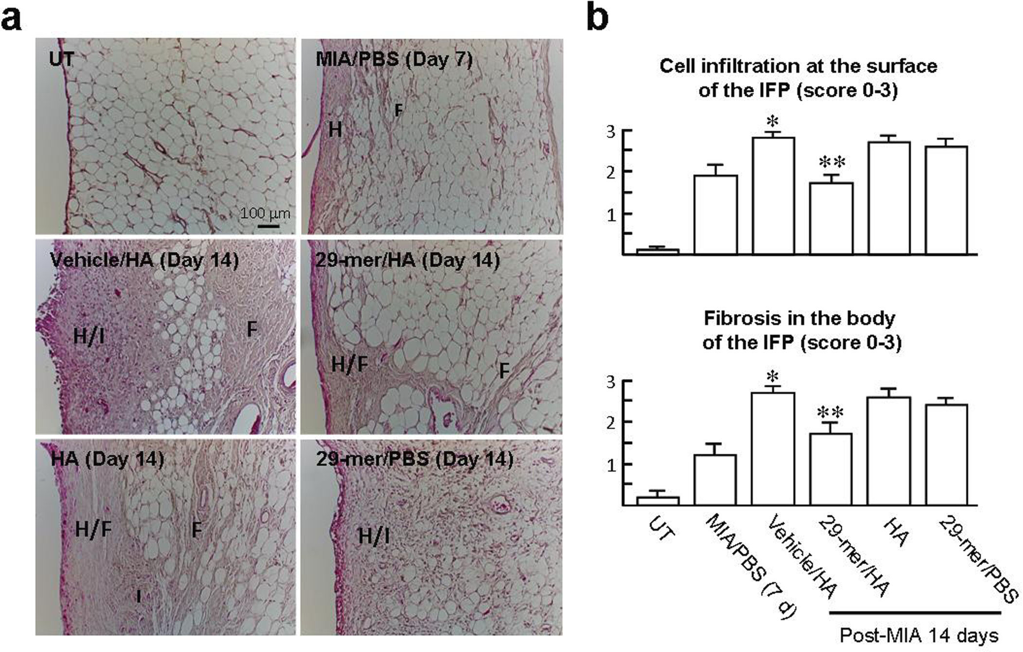Fig. 4 
            The 29-mer/hyaluronic acid (HA) blocks the development of infrapatellar fat pad (IFP) inflammation induced by monosodium iodoacetate (MIA). a) Representative histological images of haematoxylin and eosin (H&E)-stained IFP in different experimental groups after MIA injection for seven and 14 days. b) IFP inflammation score was graded by the severity of cell infiltration and fibrosis in the IFP (n = 3 per group). All p-values in this figure were calculated using one-way analysis of variance. H, cellular hyperplastic response; I, cell infiltration; F, fibrotic deposits. *p < 0.001 vs MIA/PBS group. **p < 0.01 vs vehicle/HA group. PBS, phosphate-buffered saline; UT, untreated.
          