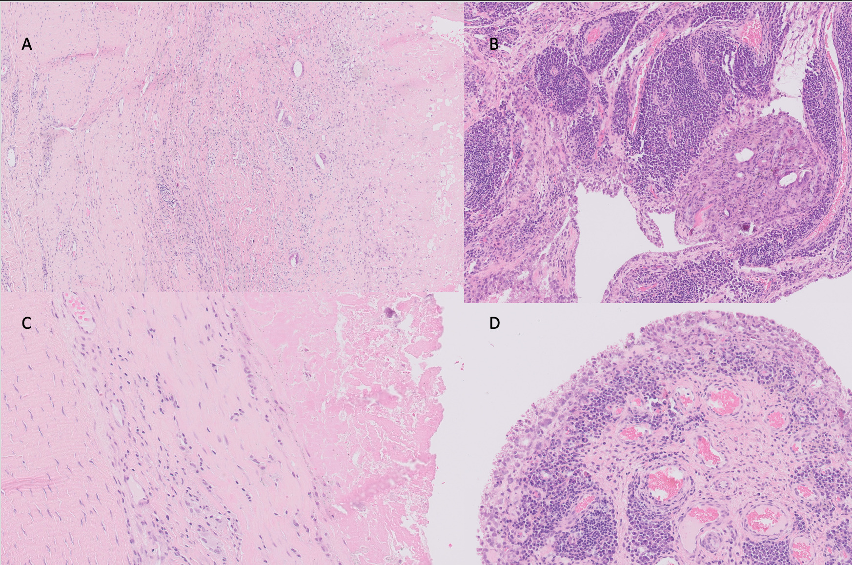 Fig. 2 
          Synovial tissue histology. a) Foreign body reaction with epithelial necrosis and macrophages. b) Chronic inflammation with perivascular plasma cells. c) Epithelial necrosis and fibrosis formation. d) Perivascular plasma cells and lymphocytes. All images were first scanned with Pathology Scanner SG300 (Philips, Netherlands), and then images were captured with Intellisite Image Management System (Philips).
        