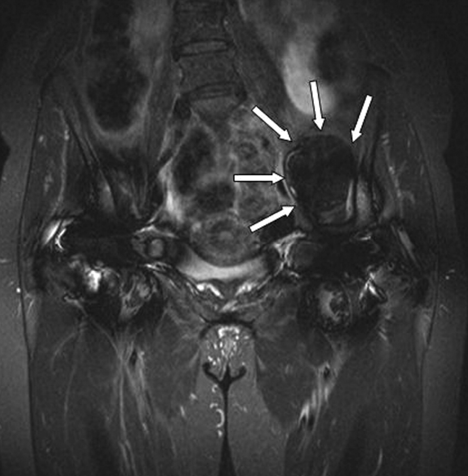 Fig. 1 
            Coronal Short TI Inversion Recovery
(STIR) MRI image of a typical example of predominantly solid pseudotumour
with low signal intensity (arrows).
          