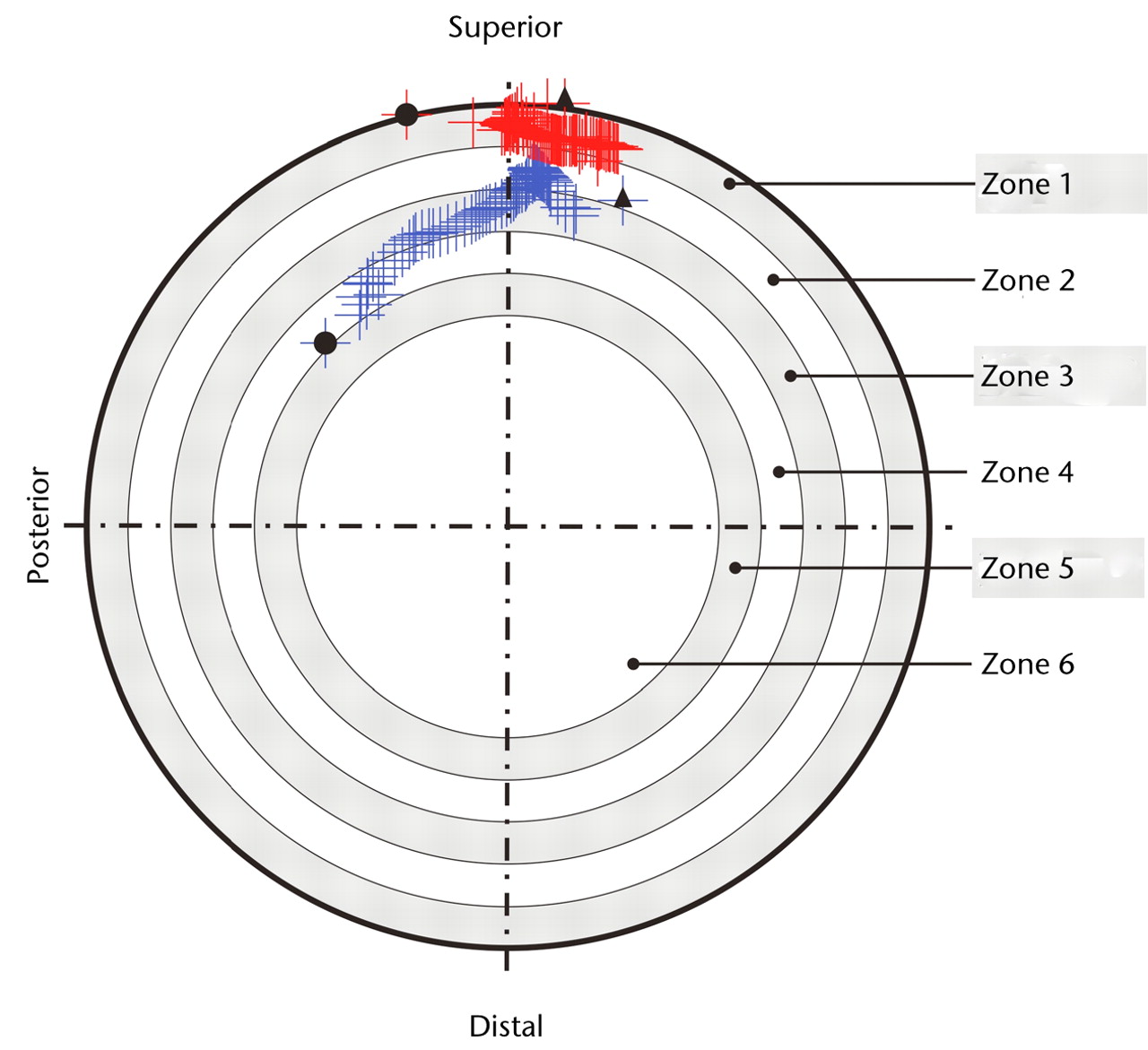 Fig. 2 
            Diagram showing force paths projected
on the acetabular component viewed in the direction through the
centre of the component. The inner bearing surface was divided into
concentric zones defined in 10% increments of the component face
radius, with the zone at the edge designated as zone 1. In hip A
(in blue), the force path does not enter the outer most radial zone
(zone 1), thus no edge-loading is observed. In hip B (in red), during
walking, the force path enters the outer most radial zone (zone 1),
indicating edge-loading. The black circles (●) indicate force path
at heelstrike and the black triangles (p) indicate force path locus
at toe-off.
          