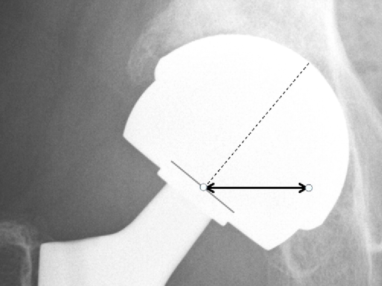 Fig. 3 
            Radiograph showing the measurement of
the horizontal lever arm (HLA) distance (bold black line). The HLA
is the horizontal distance (in mm) from a line through the axis
of the neck to the tip of the bearing surface (broken line) and
the centre of the taper engagement level.
          