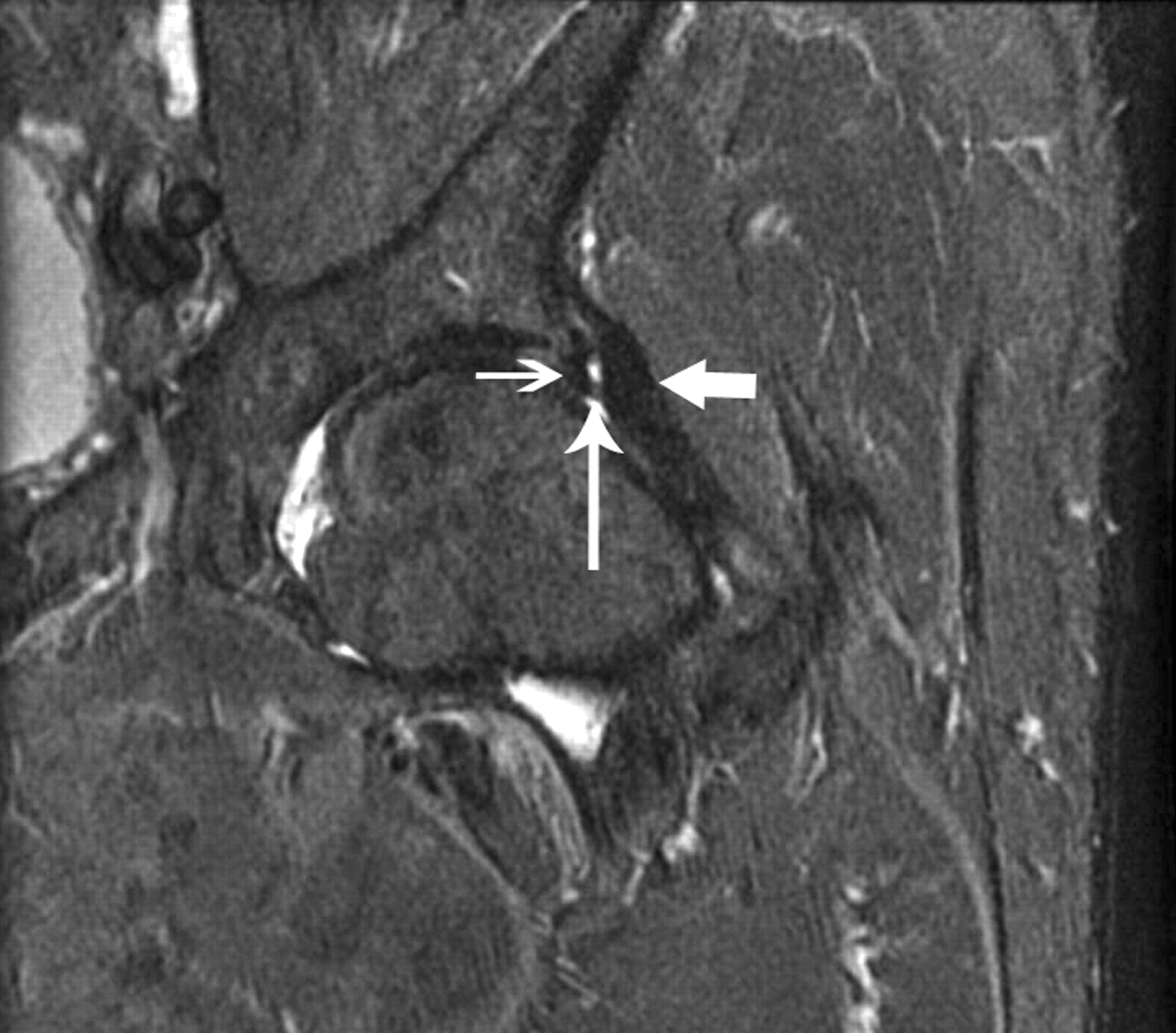 Fig. 10 
          Magnetic resonance arthrographic appearance
(STIR sequence) of a left hip, 15 months following arthroscopic labral
repair. The presence of adhesions (vertical arrow) is noted between
the labrum (thin horizontal arrow) and the capsule (thick horizontal
arrow).
        