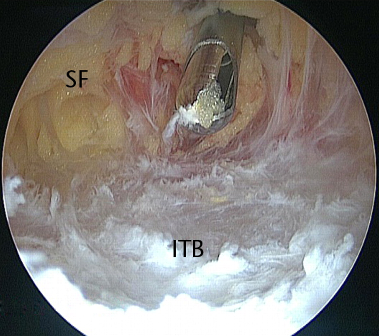 Figs. 11a - 11c 
          Arthroscopic images of the
left hip of a 64-year-old woman with persistent pain following arthroscopic
release of the iliotibial band (ITB) and excision of the trochanteric
bursa. A revision endoscopy (a) revealed that the ITB flaps had
healed back together. Upon opening of the ITB, significant adhesions (arrow)
were found to have formed in the lateral compartment (b), tethering
the ITB to the greater trochanter. After adhesiolysis and release
of the ITB as distal as the origin of the vastus lateralis (c),
there were marked improvements in symptoms, and the procedure was
repeated on the right hip after seven months, with similar success
(SF, subcutaneous fat; GT, greater trochanter; VL, vastus lateralis;
aITB/pITB, anterior/posterior flap of the iliotibial band).
        