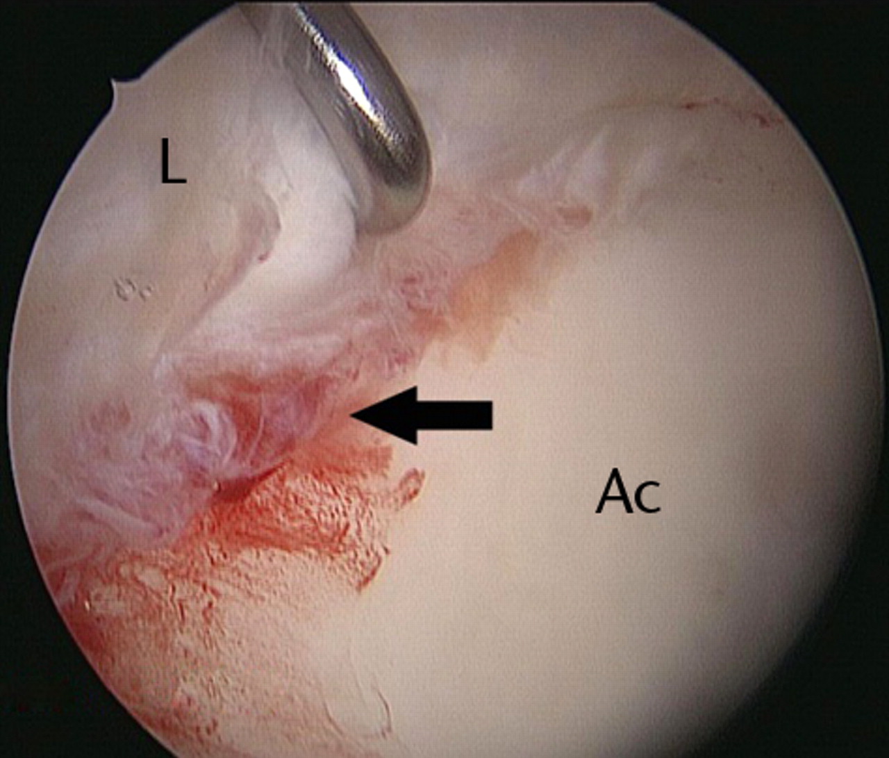 Figs. 2a - 2d 
          Arthroscopic images of the
right hip of a 53-year-old woman with mild dysplasia, showing a)
significant hypertrophy of the anterosuperior labrum, leaving little
room for the 5 mm dilator and guide wire inserted through the anterior
portal, b) the radiofrequency ablation probe just interposed safely
between the labrum and the femoral head, c) partial labral detachment
(arrow), and d) improved visualisation after labral repair with
a suture anchor (arrow) (L, labrum; FH, femoral head; Ac, acetabulum).
        