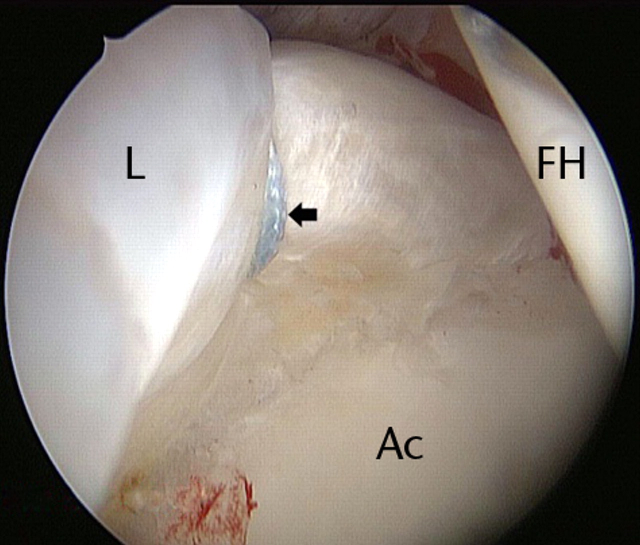 Figs. 2a - 2d 
          Arthroscopic images of the
right hip of a 53-year-old woman with mild dysplasia, showing a)
significant hypertrophy of the anterosuperior labrum, leaving little
room for the 5 mm dilator and guide wire inserted through the anterior
portal, b) the radiofrequency ablation probe just interposed safely
between the labrum and the femoral head, c) partial labral detachment
(arrow), and d) improved visualisation after labral repair with
a suture anchor (arrow) (L, labrum; FH, femoral head; Ac, acetabulum).
        