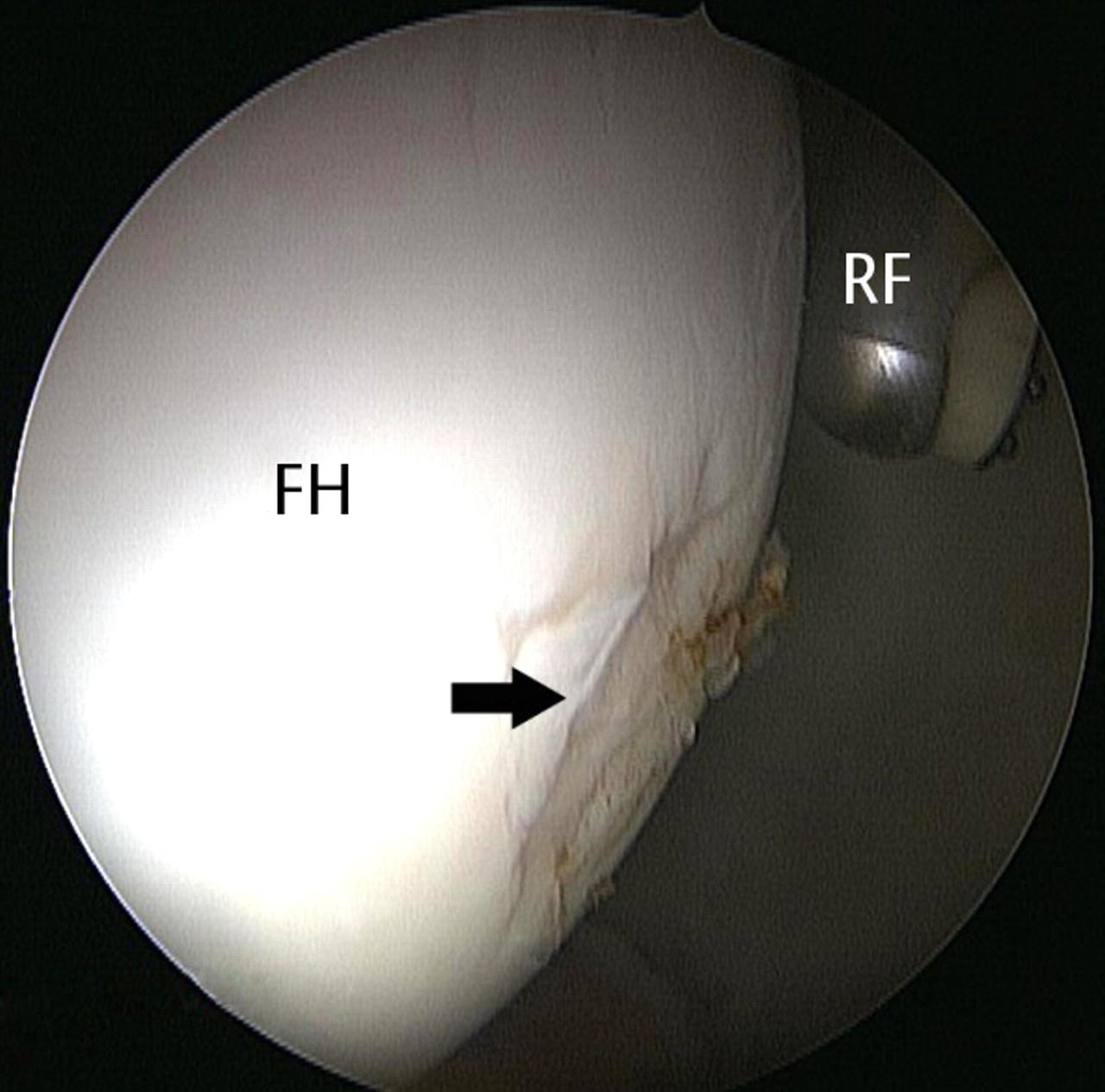 Fig. 3 
          Arthroscopic image showing iatrogenic
partial-thickness chondral scuffing (black arrow) of the femoral
head (FH) in a 40-year-old man undergoing labral repair with three
suture anchors. The radiofrequency ablation probe (RF) was used
to smooth the scuffed area of the femoral head.
        