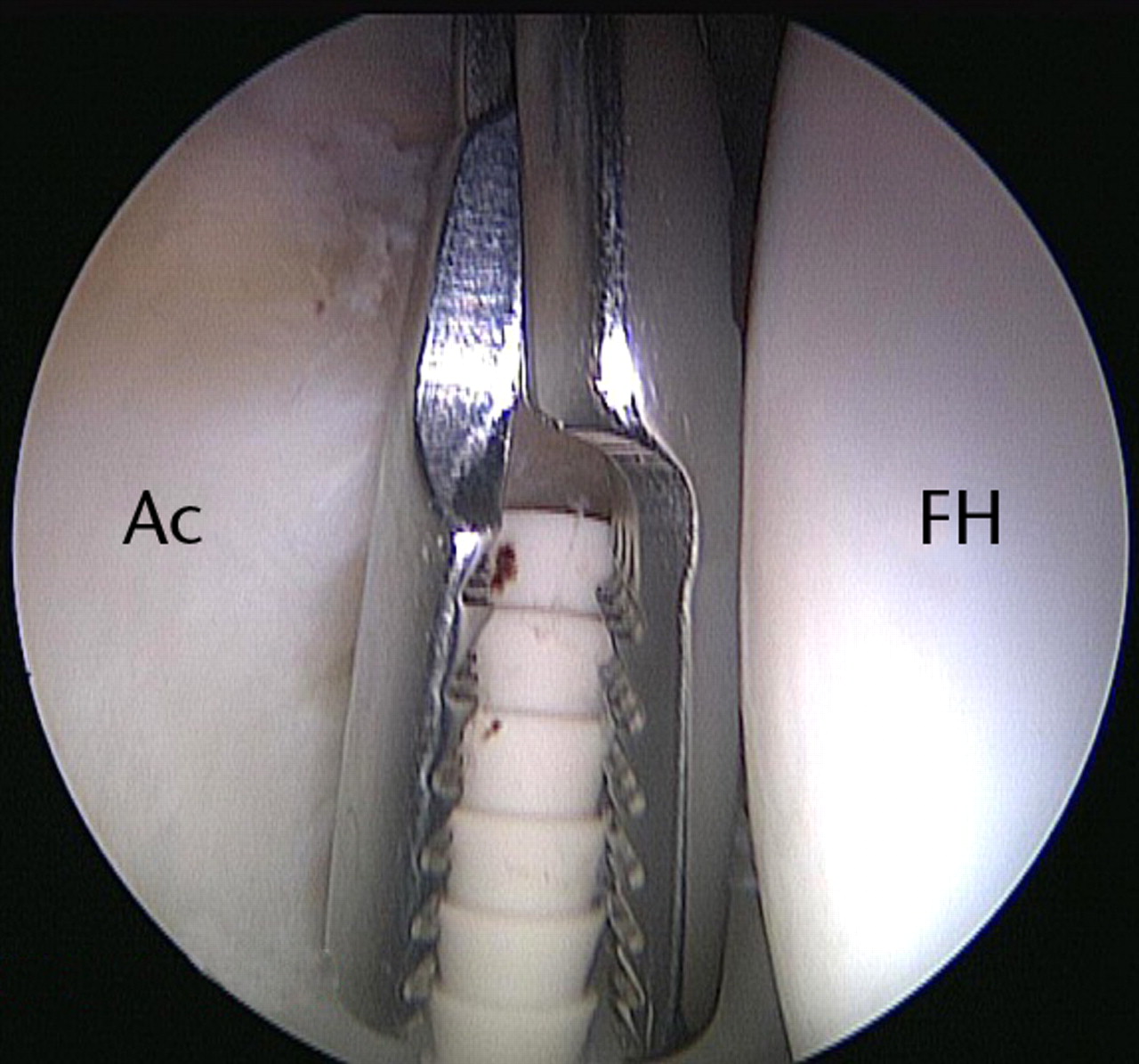 Fig. 5 
          Arthroscopic image showing retrieval
of a broken suture anchor from the anterior joint space of the central compartment
during attempted labral repair (FH, femoral head; Ac, acetabulum).
        