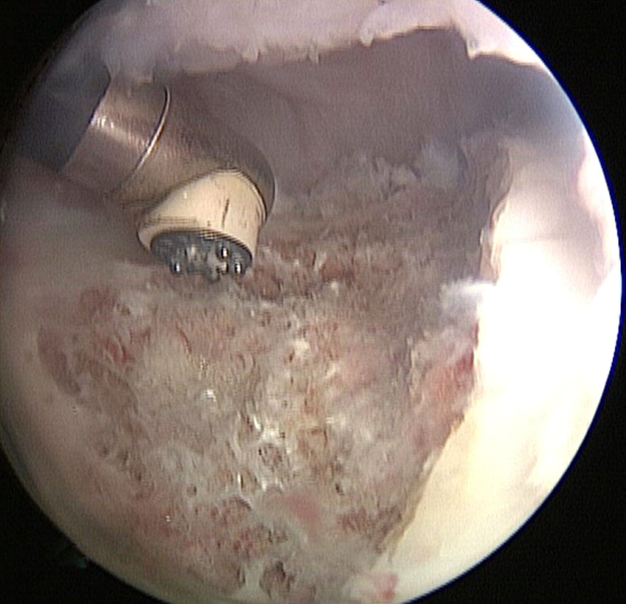 Figs. 6a - 6b 
            Arthroscopic images of the peripheral
compartment of a left hip, a) after femoral osteochondroplasty,
showing the exposed bleeding surface of raw cancellous bone, and
b) after treatment with the radiofrequency ablation probe for haemostasis.
          