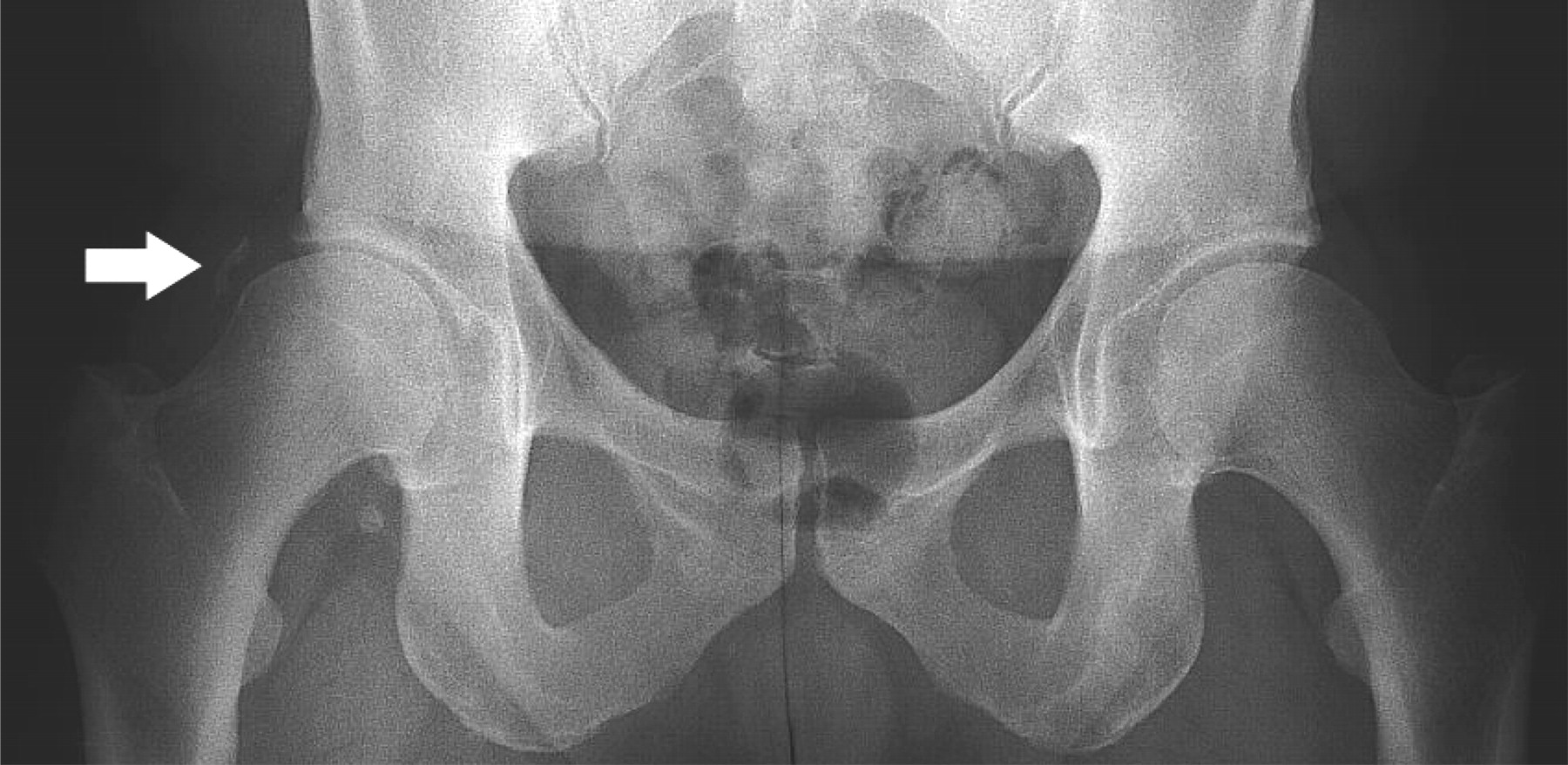 Fig. 7 
          Anteroposterior standing pelvic radiograph
of a 52-year-old man showing mild joint space narrowing and minor
heterotopic calcification (white arrow) of the right hip, after
two arthroscopies of that joint with no post-operative prophylaxis given
for heterotopic ossification.
        