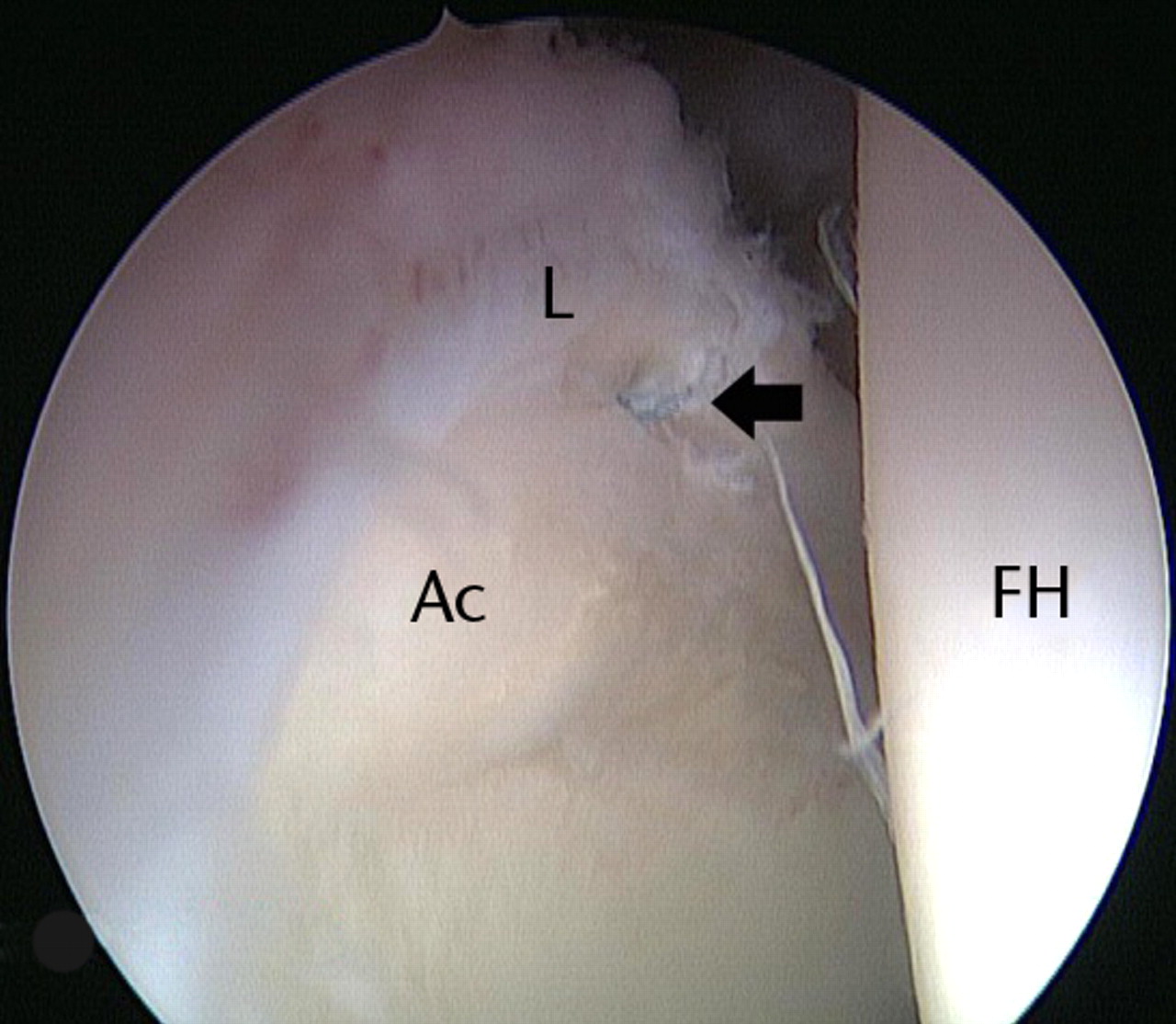 Figs. 8a - 8b 
          
            Figure 8a – arthroscopic image of
a successful labral repair with use of the vertical mattress technique
leaving the articular edge of the labrum free, with the suture barely
visible (arrow). Figure 8b – arthroscopic image after an unsuccessful
labral repair (cinch stitch technique) in which the suture cut through
the labrum, showing the final appearance of debridement of the anterosuperior
labrum (short arrow). Acetabular chondroplasty was also performed
in that case (long arrow) (L, labrum; FH, femoral head; Ac, acetabulum).
        