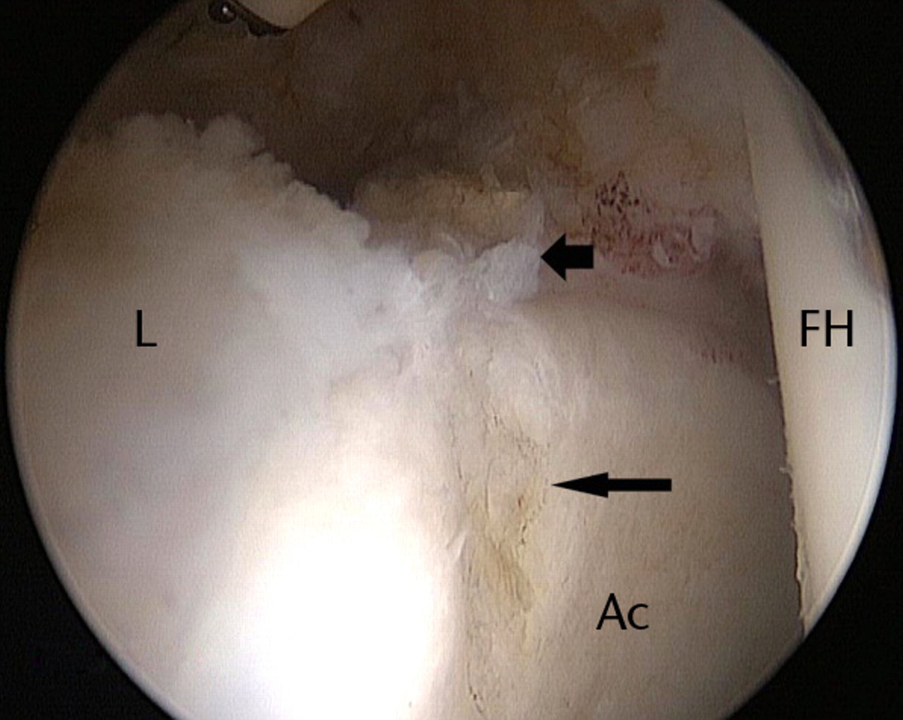 Figs. 8a - 8b 
          
            Figure 8a – arthroscopic image of
a successful labral repair with use of the vertical mattress technique
leaving the articular edge of the labrum free, with the suture barely
visible (arrow). Figure 8b – arthroscopic image after an unsuccessful
labral repair (cinch stitch technique) in which the suture cut through
the labrum, showing the final appearance of debridement of the anterosuperior
labrum (short arrow). Acetabular chondroplasty was also performed
in that case (long arrow) (L, labrum; FH, femoral head; Ac, acetabulum).
        